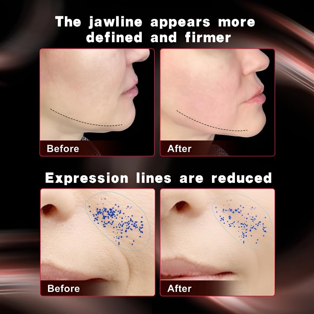 Dispositivo de Reducción de Belleza de Radiofrecuencia RF NEWA, Dispositivo de Apretado para Uso Doméstico para Rejuvenecimiento de la Piel, Eliminación de Arrugas, Apretado de la Piel, Manchas Claras