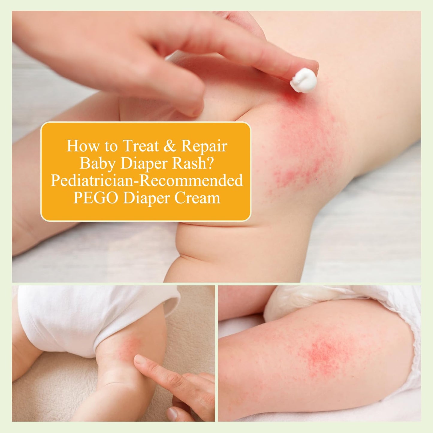 AOAO Crema para la dermatitis del pañal en bebés: recomendada por pediatras para prevenir, aliviar y tratar brotes y brotes de dermatitis del pañal. Protege la piel del bebé (100 ml, 3.38 onzas líquid