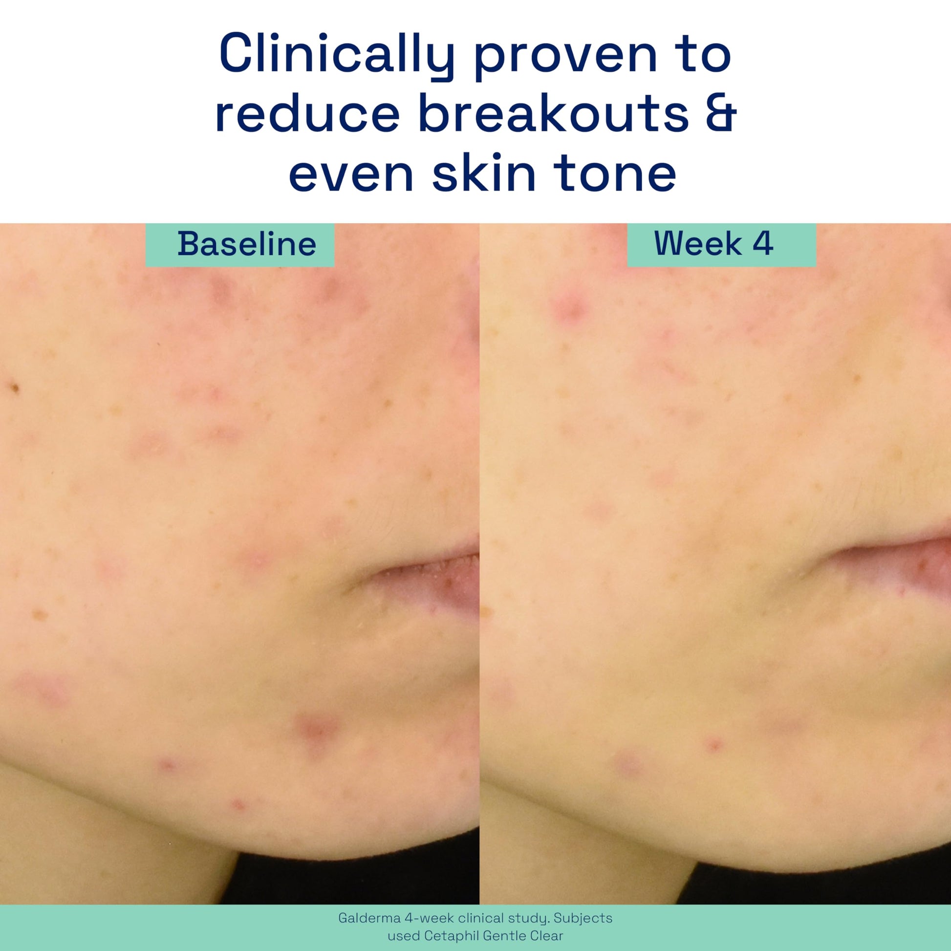 Cetaphil Gentle Clear Triple Accion Acne Serum 30ml