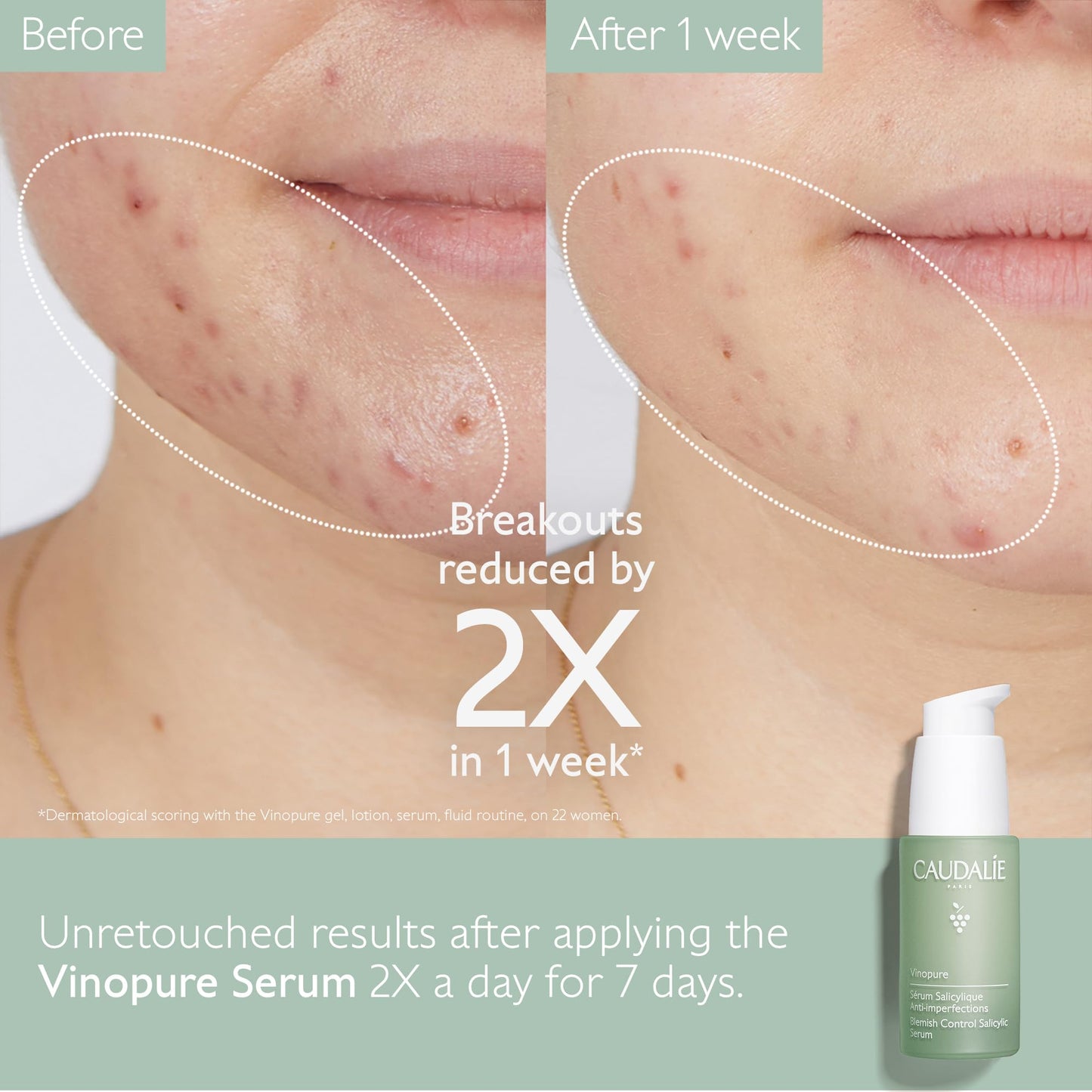 Caudalie Vinopure Set Esencial para Piel con Tendencia Acneica con Sérum Vinopure de Tamaño Completo + 2 Productos de Viaje Gratis (Valor de $1615)