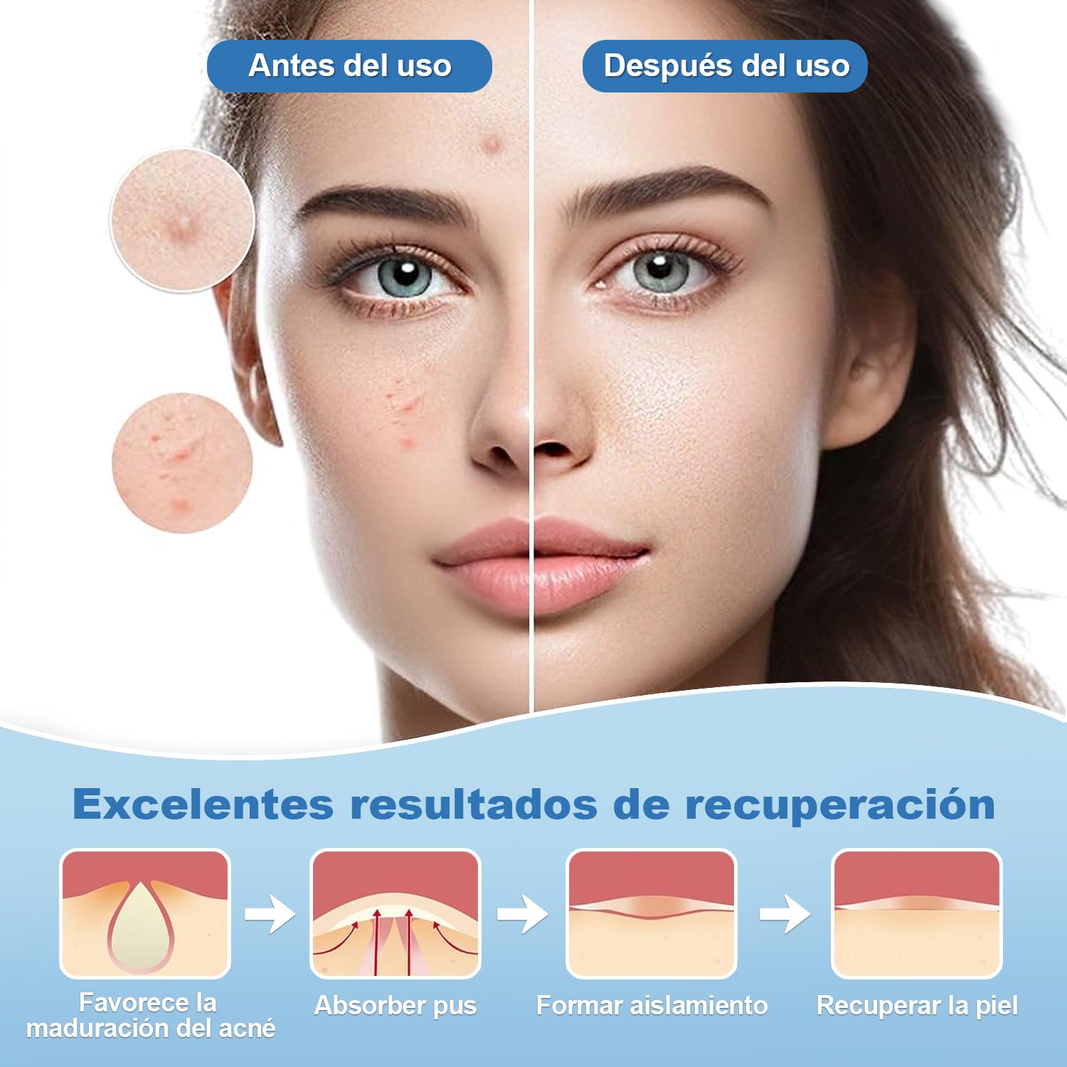 Parches para Acne,Pimple Patch,200 Almohadillas Hidrocoloides para Espinillas, Parches para Espinillas, Pimple Reduce Enrojecimiento,Forma de Estrella, Pueden Absorber la Secreción (Rojo)