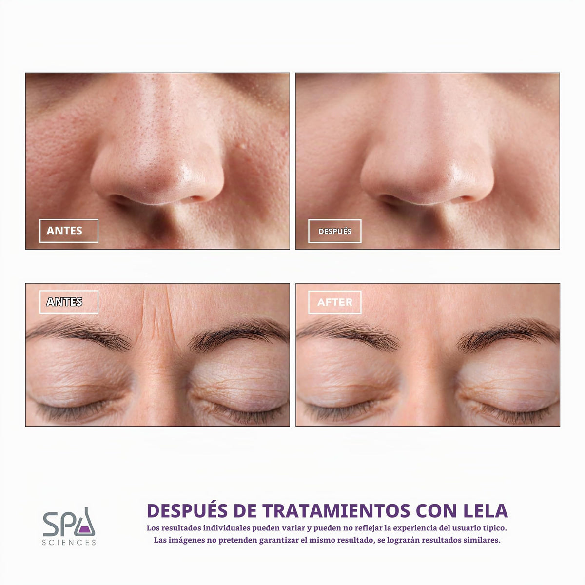 Spa Sciences LELA - Sonic Skin Spatula - for Deep Cleansing, Extraction, Serum Infusion and Lifting - 5 Treatment Modes - for All Skin Types - Rechargeable