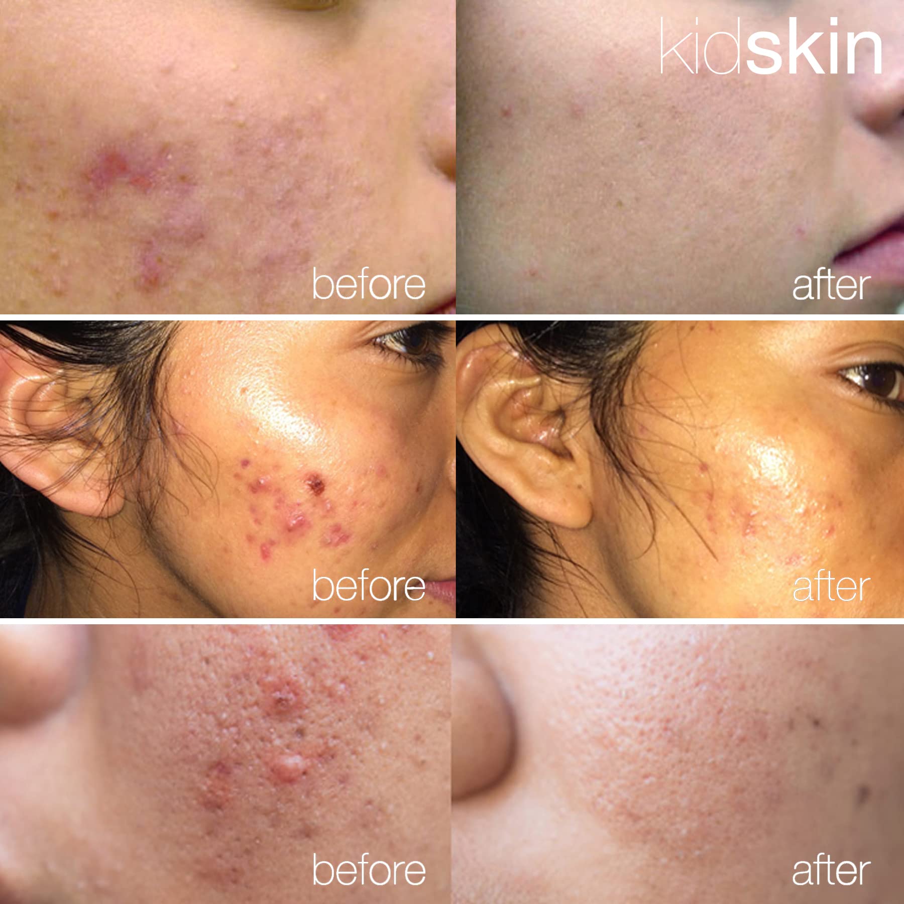 Kidskin - Z-Blast Acne Serum, Preteens, and Teens - Acne Serum - Pimple and Breakout Prevention - 2% Salicylic Acid