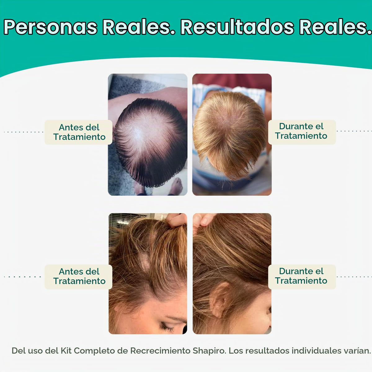 Acondicionador Shapiro MD Natural Marrón con Bloqueadores DHT Poderosos para Cabello Más Grueso y Saludable
