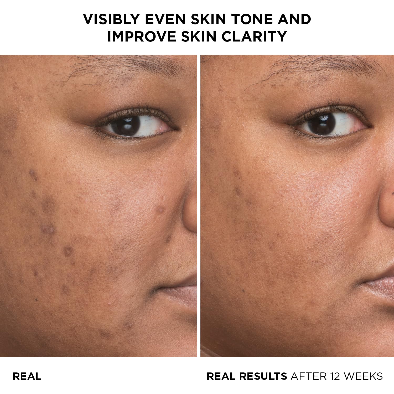 It Cosmetics Bye bye Dark Spots, Serum, Suero 4% Niacinamida Reduce las Manchas Oscuras y Mejora la Textura de la Piel en 8 Semanas, con 1% de Vitamina C Etílica, Todo Tipo de Piel, 30 ml