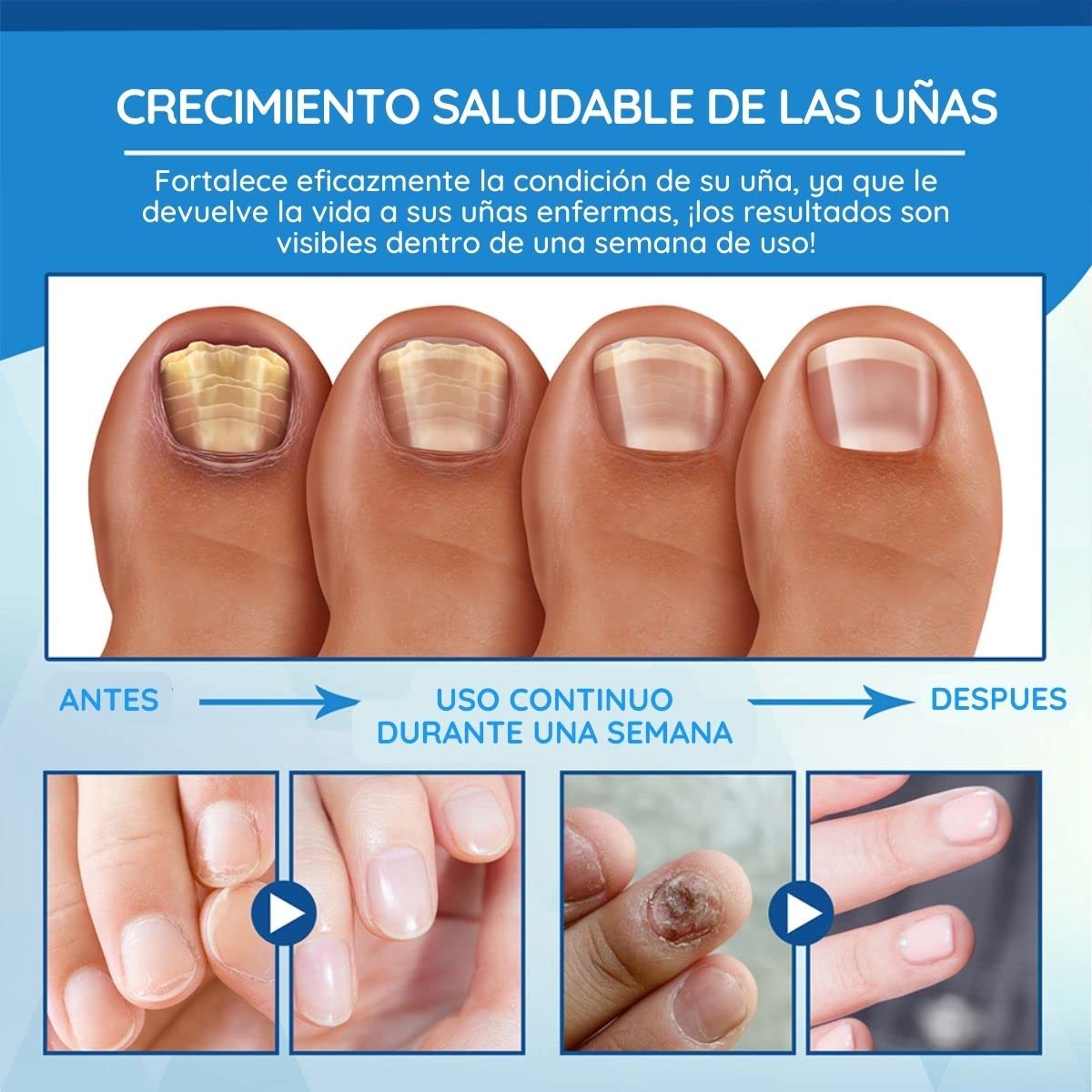 EELHOE Bolígrafo Luz Azul para Tratamiento de Hongos en Uñas - Elimina Onicomicosis y Paroniquia
