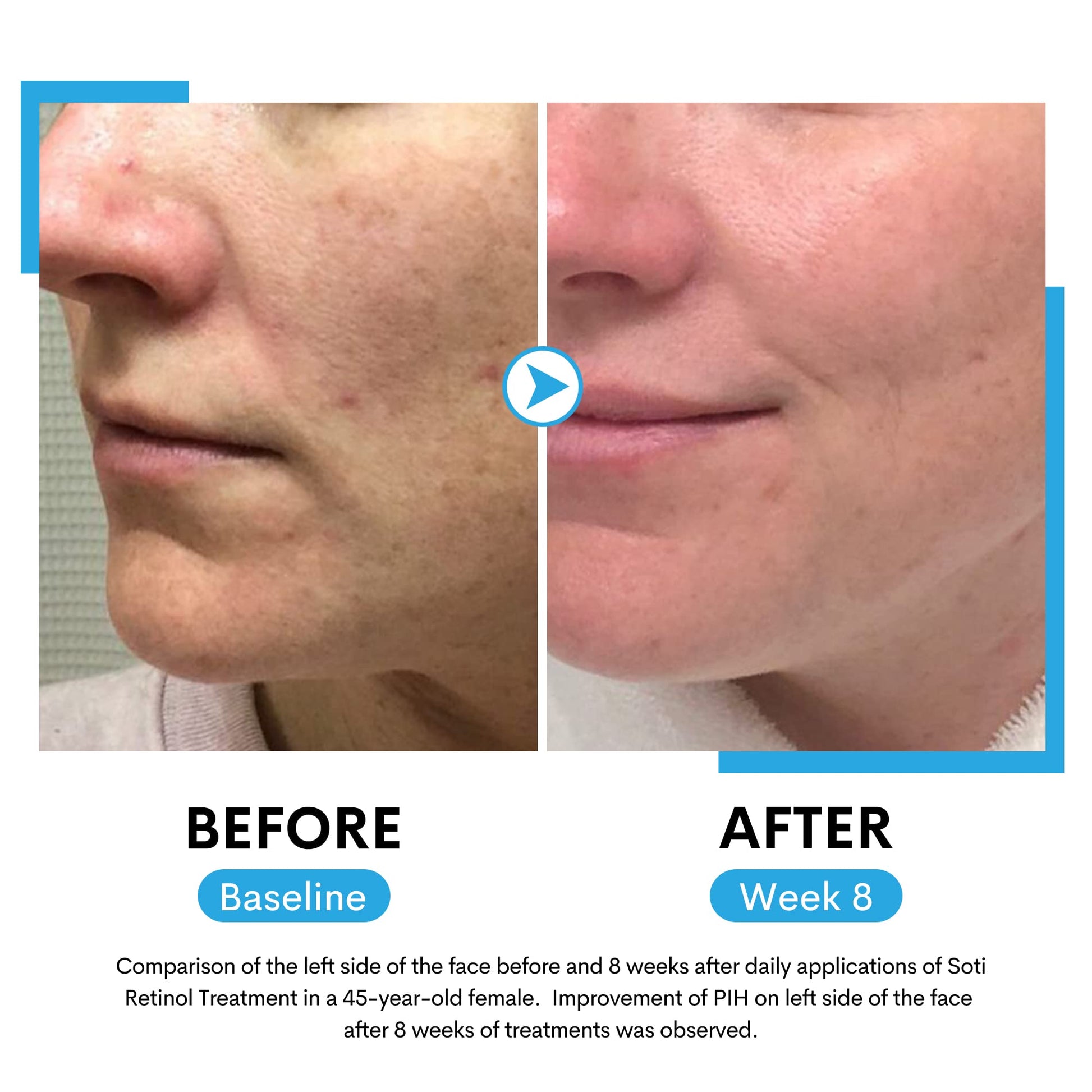 Soti 2.5% Retinol Serum, Made in USA! Reduces Wrinkles, Age Spots, Post-Acne Marks. Stimulates Collagen, Firm Skin, Anti Aging with Hyaluronic Acid, Niacinamide, 30ml