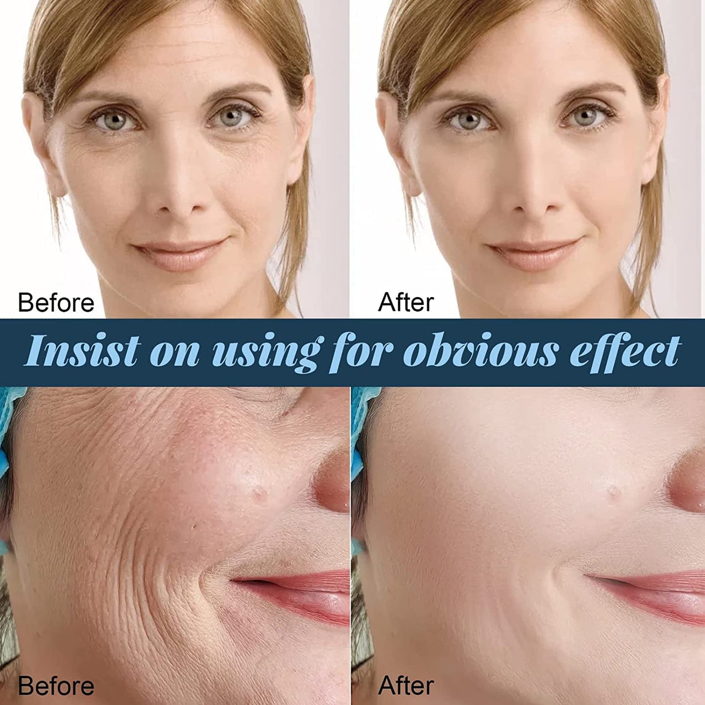 Hilo de proteína soluble coreano, hilo de colágeno para levantar instantáneamente la proteína facial, hilos de colágeno absorbentes, juego de levantamiento de hilos de proteína, reduce las arrugas de líneas finas, para mujeres (3 cajas)