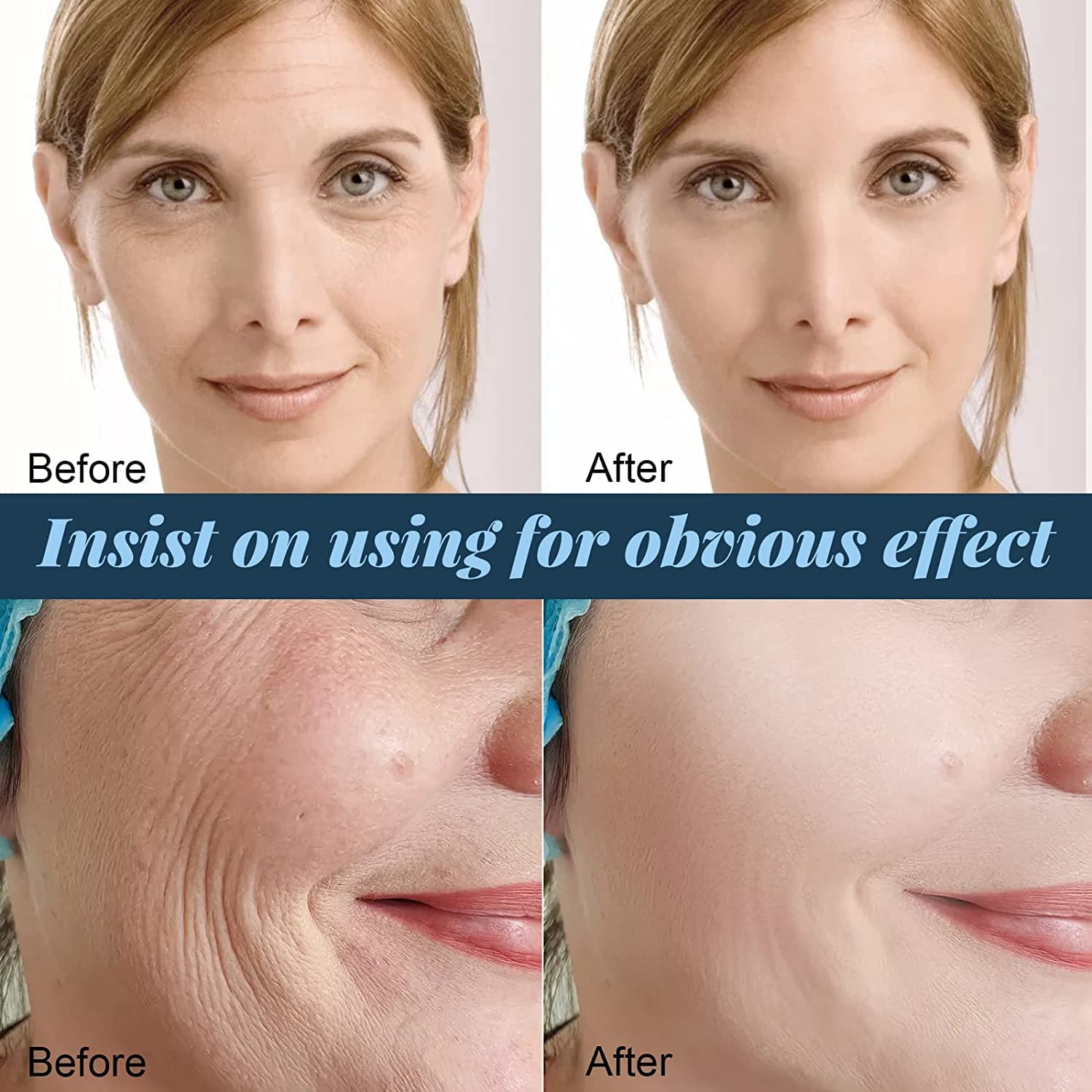 Hilo de proteína soluble coreano, hilo de colágeno para levantar instantáneamente la proteína facial, hilos de colágeno absorbentes, juego de levantamiento de hilos de proteína, reduce las arrugas de líneas finas, para mujeres (3 cajas)