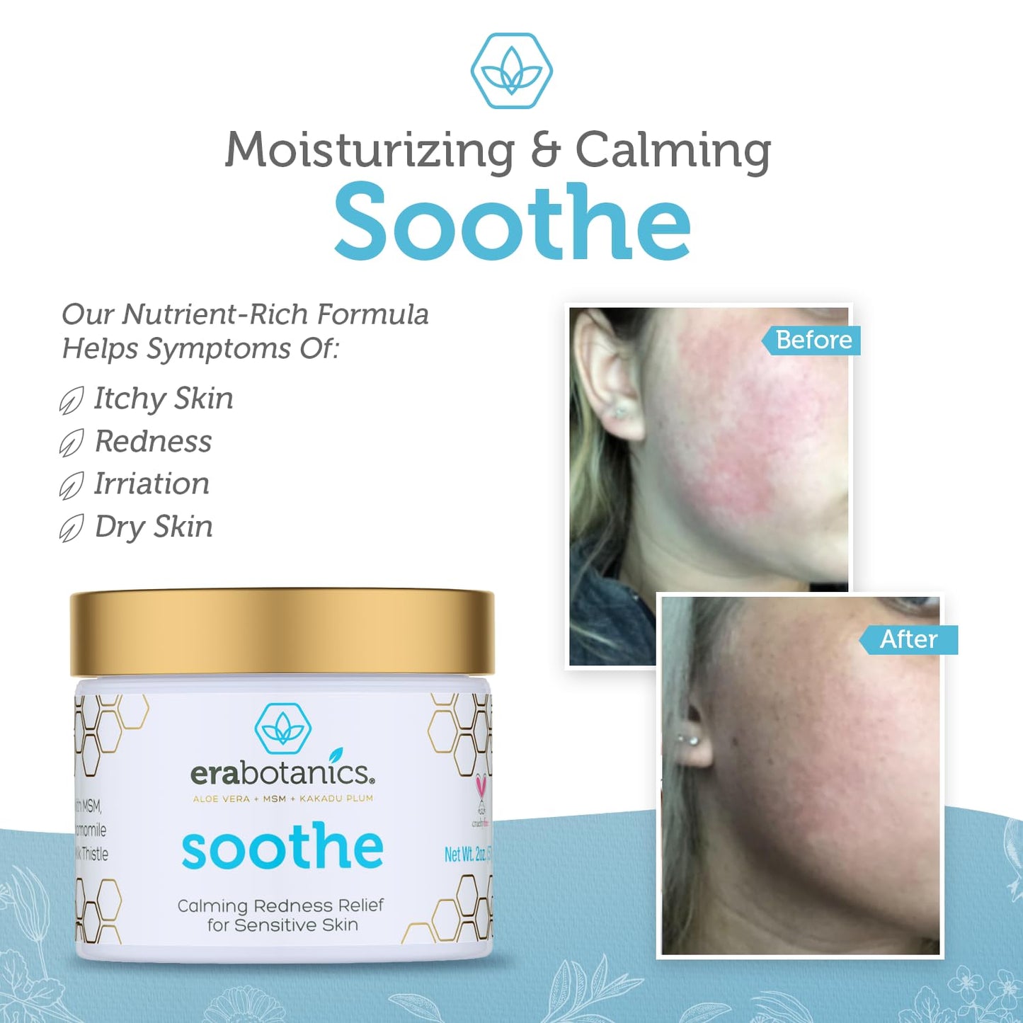 Rosacea Redness Relief Treatment Cream - Soothe Anti Inflammatory Natural Face Moisturizer Cream For Rosacea, Eczema, Acne, Dry, Sensitive Skin With Milk Thistle, MSM, Avocado Oil & Chamomile