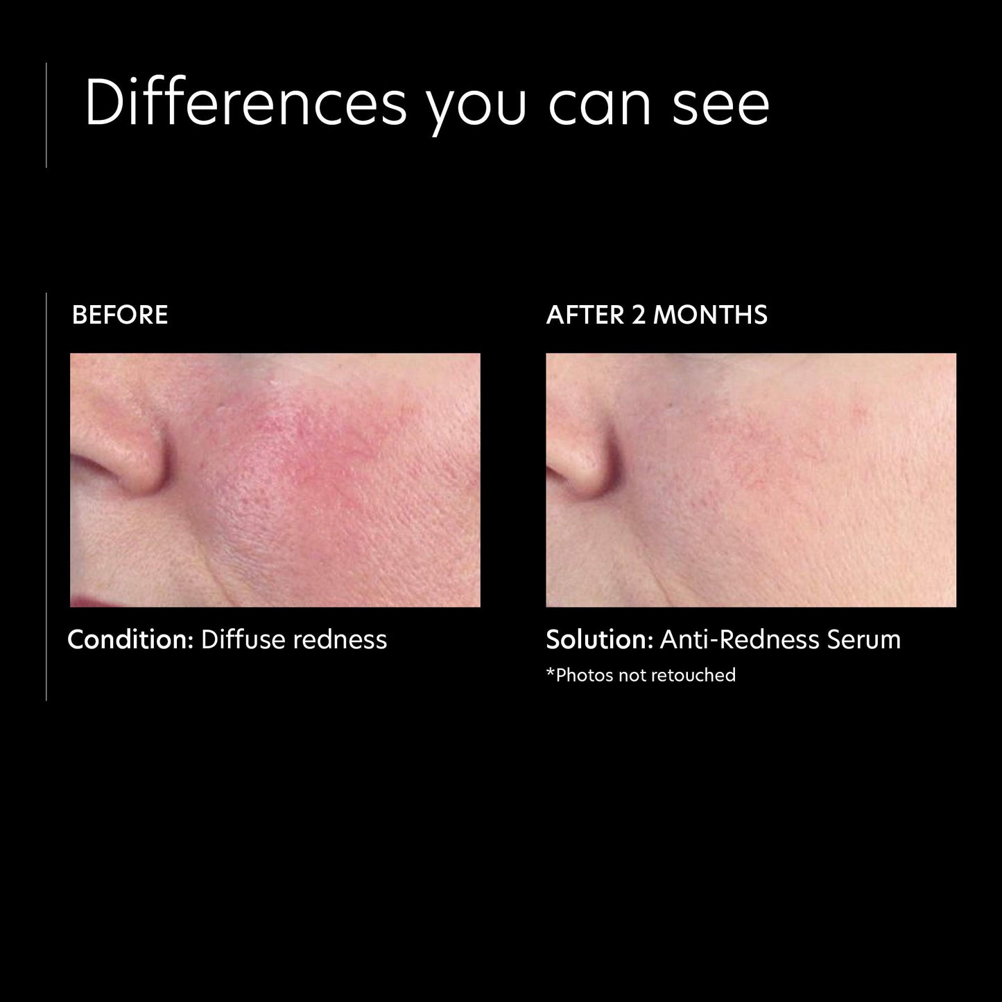 PCA SKIN Anti-Redness Serum, 1 fl. oz.
