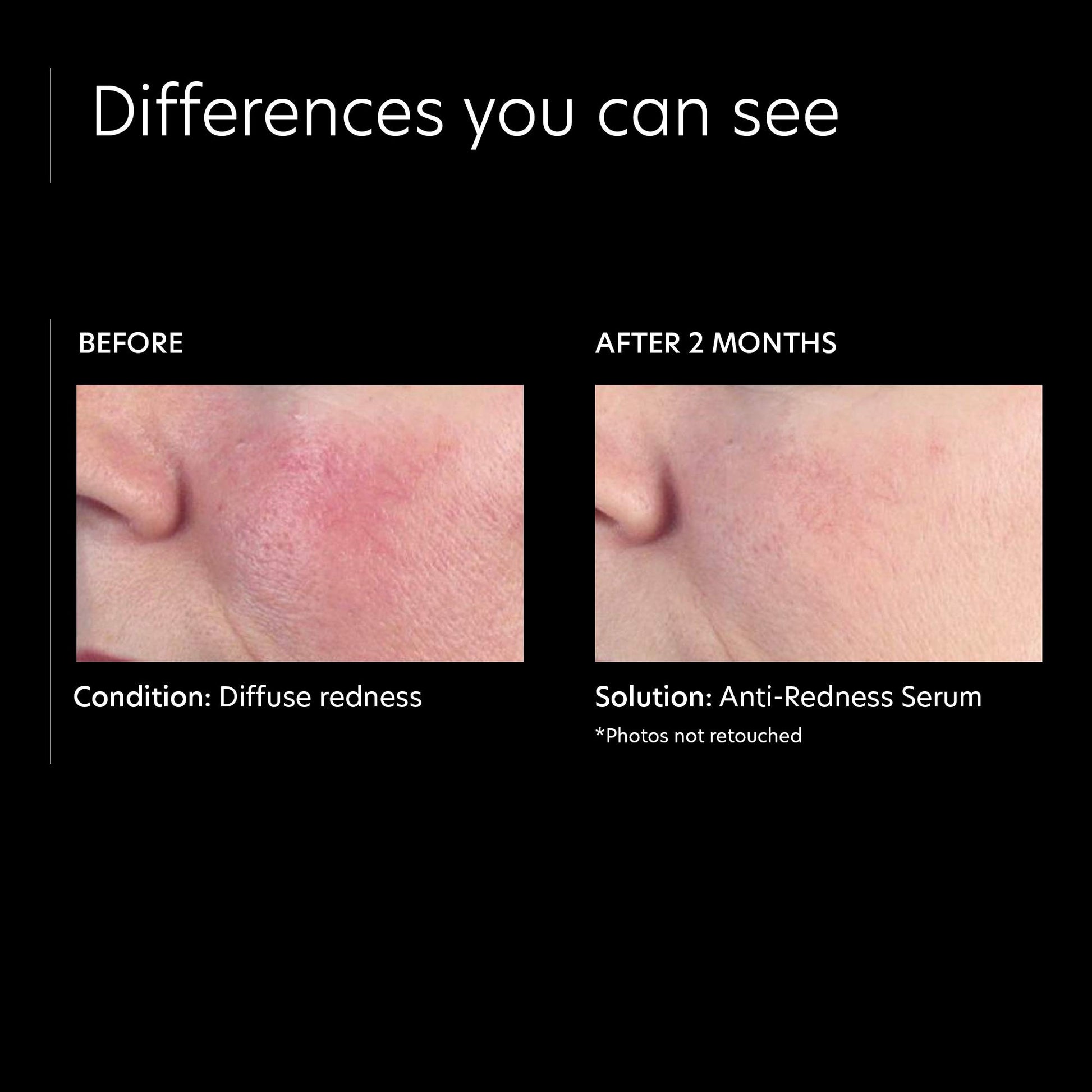 PCA SKIN Anti-Redness Serum, 1 fl. oz.