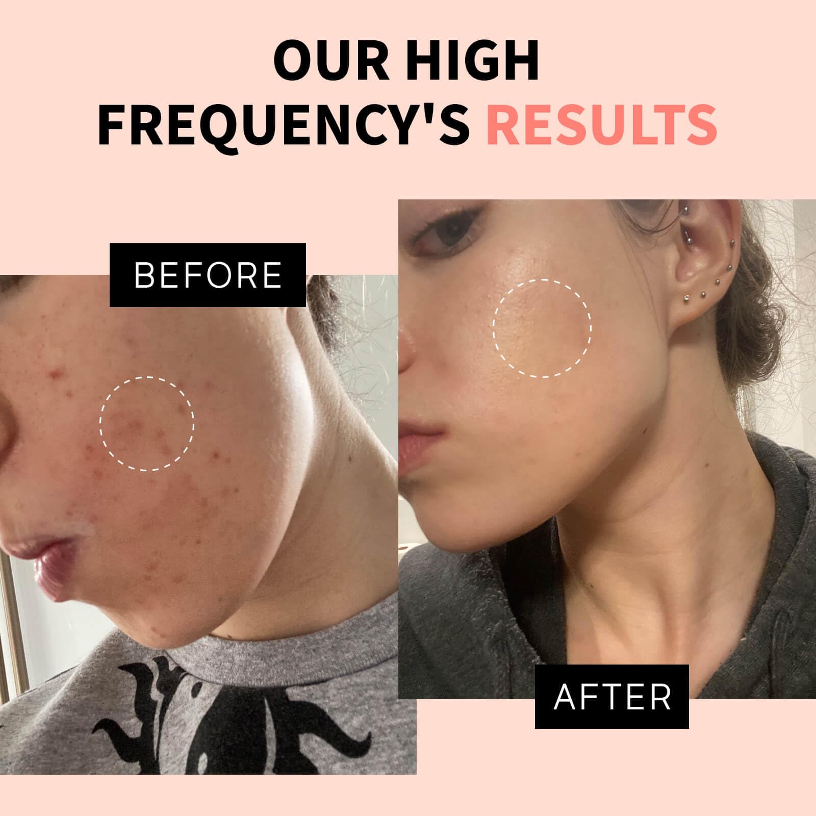 Máquina facial de alta frecuencia inalámbrica OxyGlow 2, varita de terapia clínica para la piel ProFacialWand con gas xenón