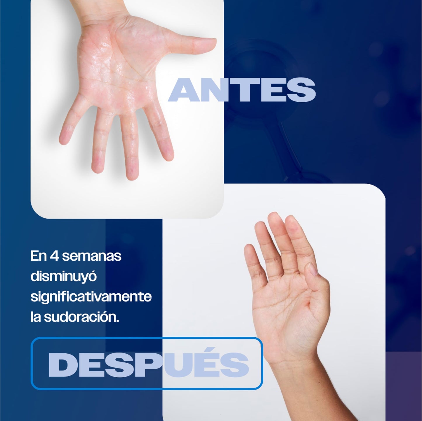 SKINDRY Sensitive Desodorante Mujer y Hombre para Pieles Sensibles y Sudoración Excesiva | 48 hrs de Protección | Antitranspirante Natural para Axilas, Pies, Manos, Espalda, Cuero Cabelludo | 20 ml