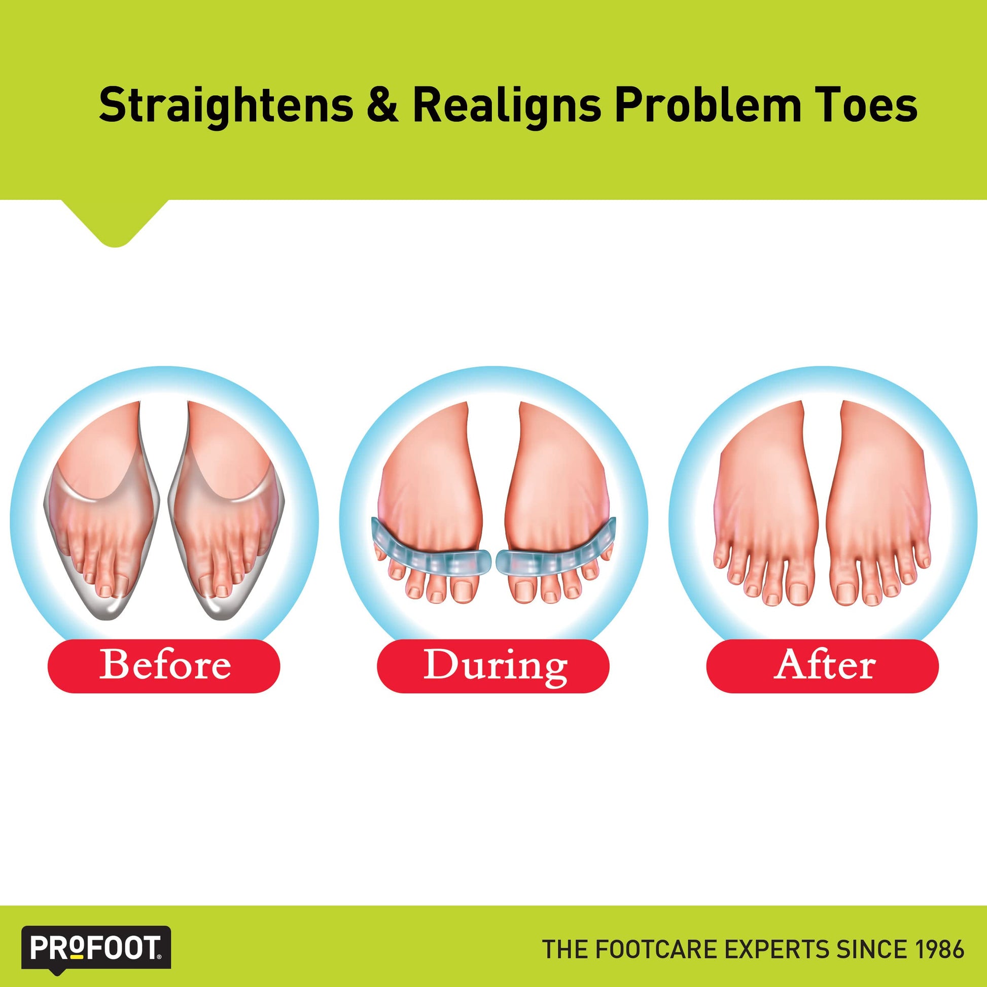 Relajantes para Dedos del Pie Profoot Flex-tastic Ajustables 2 Unidades