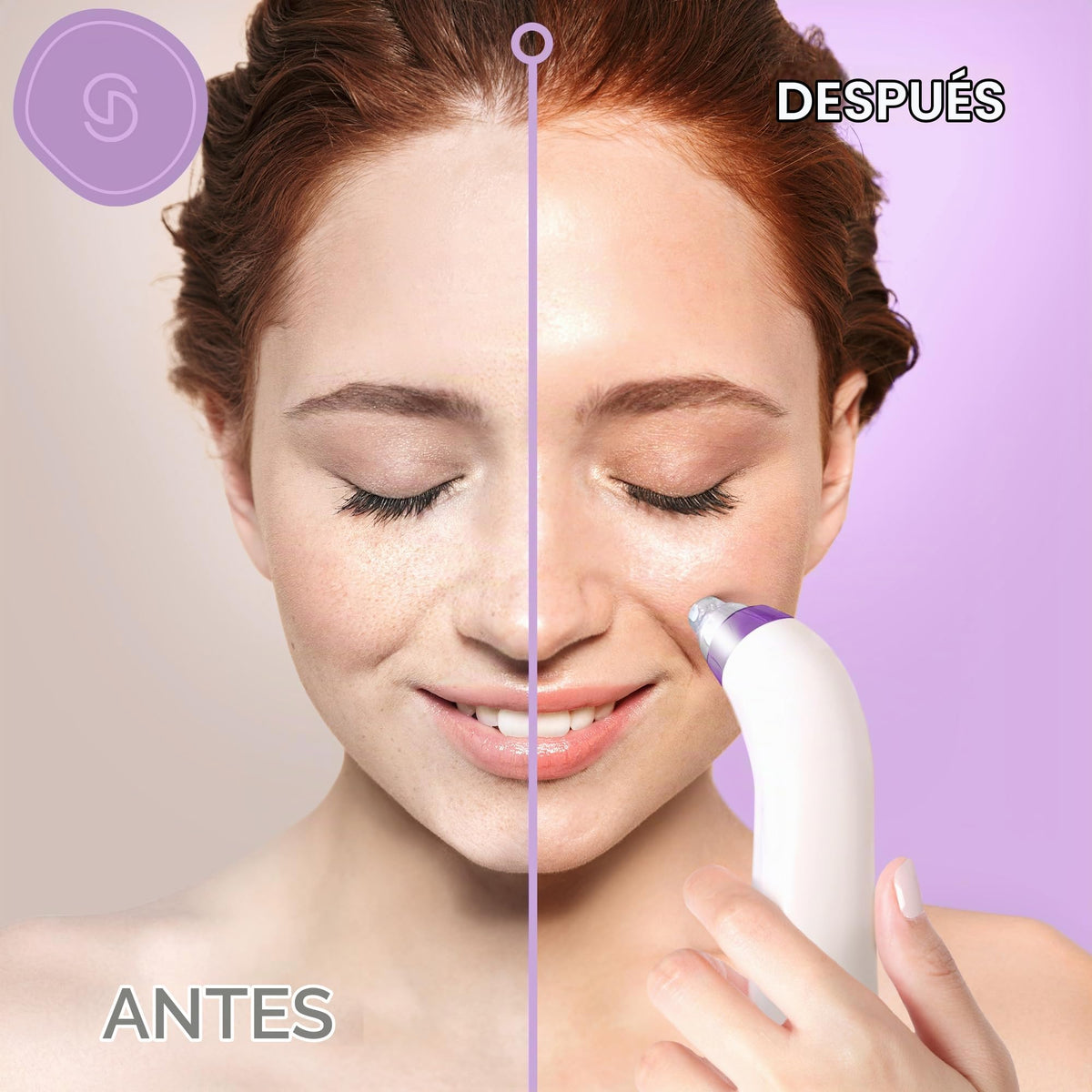 Essy máquina limpiadora facial para aspiración de espinillas (morado)