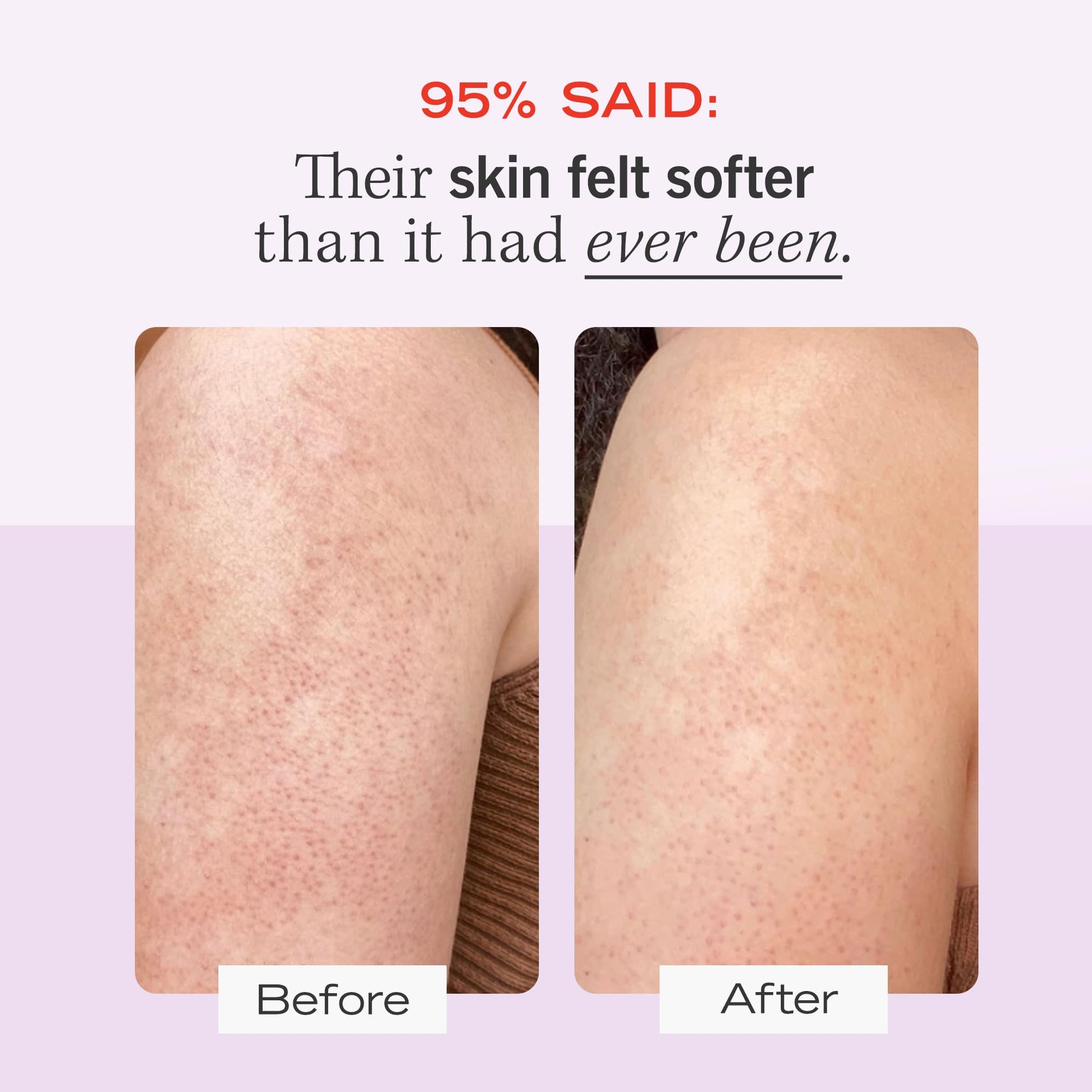 First Aid Beauty- Exfoliante corporal KP Bump Eraser con 10% de AHA, exfoliante para piel con queratosis pilaris con ácido glicólico y lactosa.