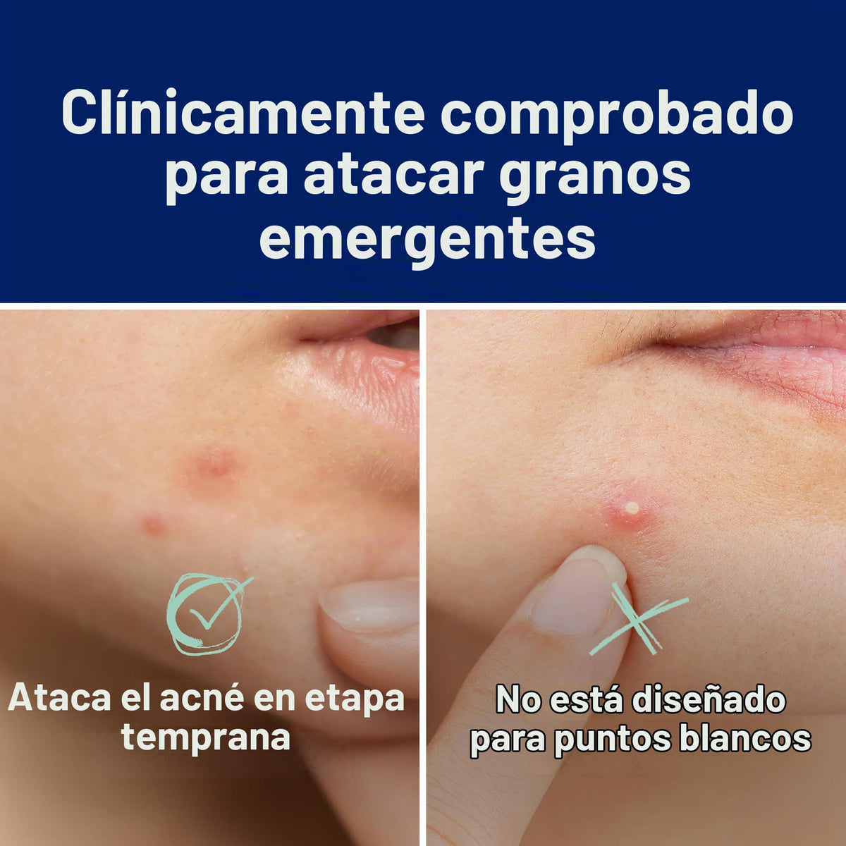 Cetaphil - Parche de rescate rápido para acné