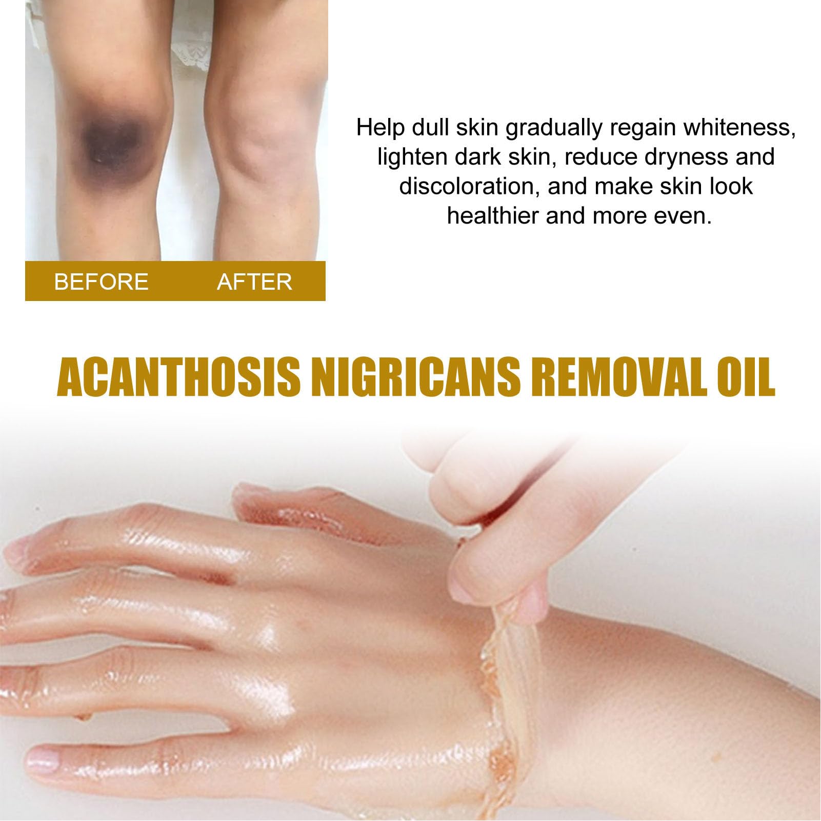 Dioche 3 Piezas 50ml Aceite Exfoliante, Acantosis Nigricans Peeling Aceite para Piel Oscura, No Graso Aclara el Tono de la Piel Corrector de Manchas Oscuras Aceite Peeling