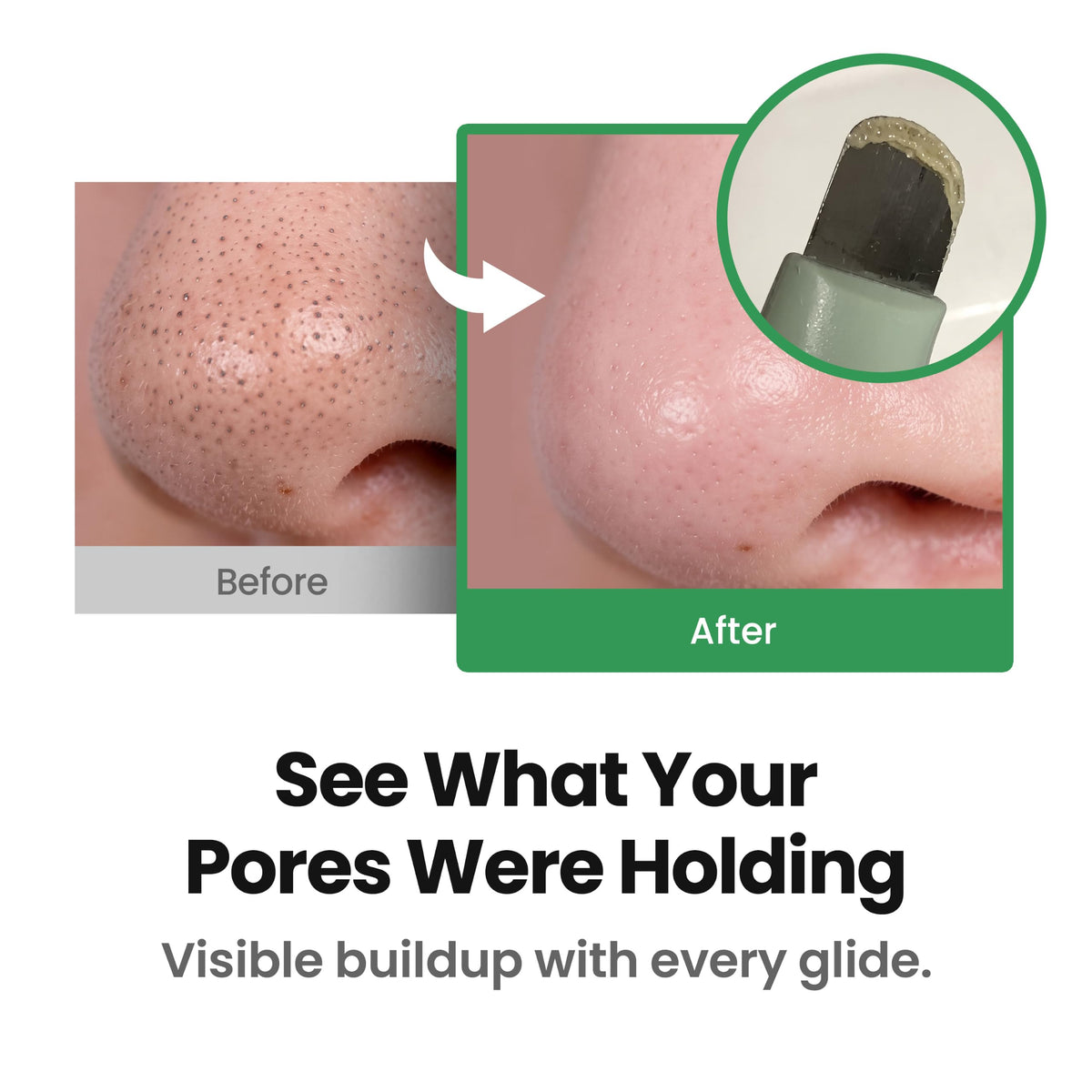 ILSO Limpiador de Puntos Negros y Sebo - Herramienta Facial de Acero Inoxidable para Limpieza Profunda de Poros, Removedor de Impurezas y Exceso de Grasa