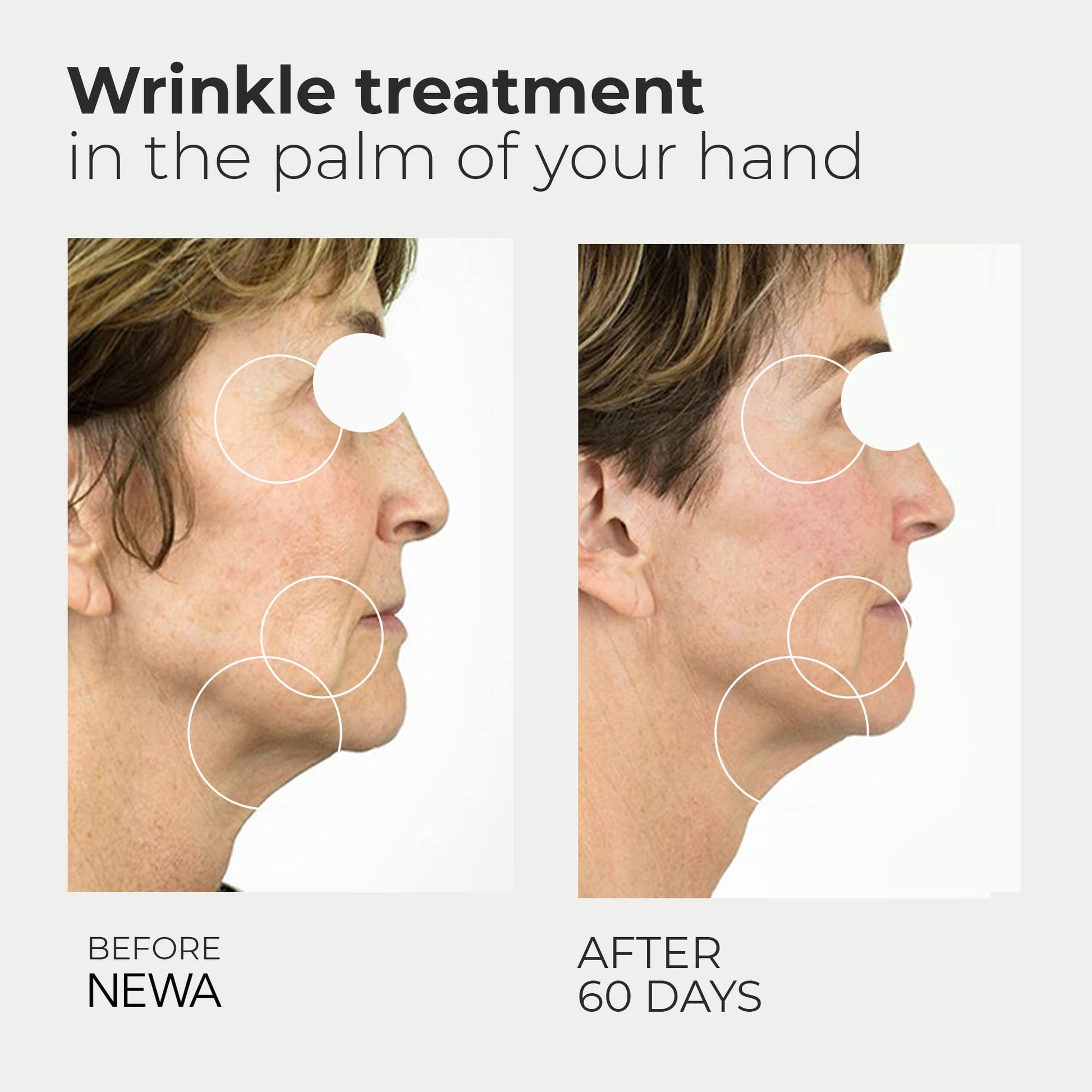 Sistema de cuidado de la piel NEWA, tratamiento facial antienvejecimiento, tecnología de reafirmación de la piel para uso doméstico. El nuevo colágeno que desencadena reduce las arrugas, estira y levanta la piel. FDA despejado, color rosa, Lavanda