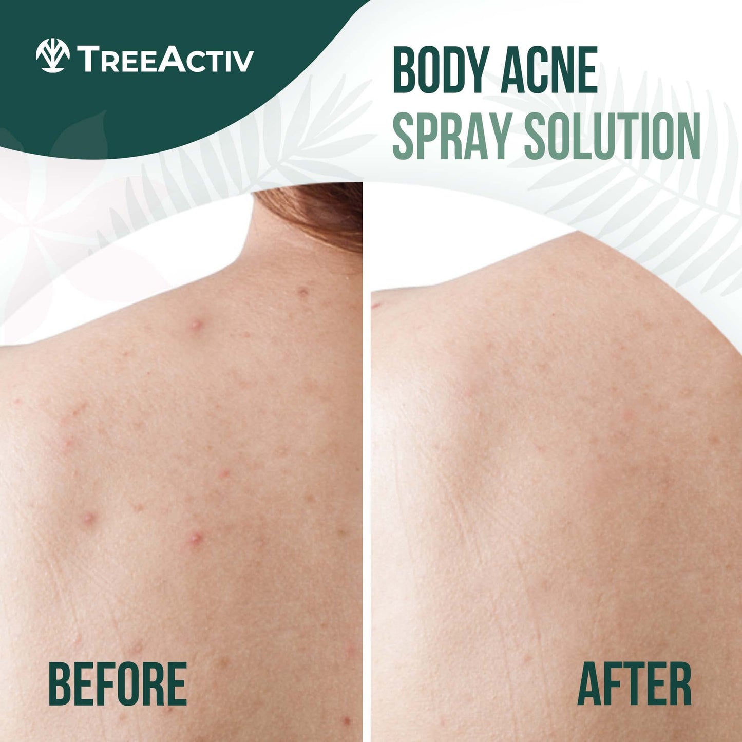 Spray de Ácido Salicílico TreeActiv para Espalda y Cuerpo Solución Eficaz Corporal en Mujeres y Hombres Fórmula de Secado Rápido con Aceite de Árbol de Té, 2 Frascos de 120ml