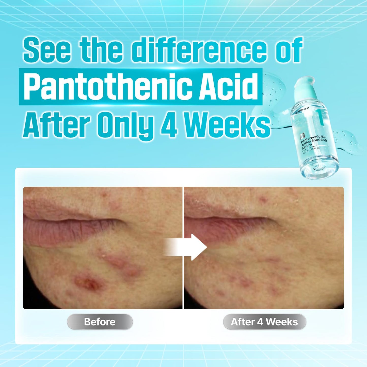 numbuzin Suero No.1 | Suero Calmante Activo Pantoténico B5 | Calmante, Hidratante | Ácido Pantoténico, Niacinamida | Control Del Exceso De Aceite, Reduce Los Brotes, Acné | Piel Grasa, Propensa Al Acn