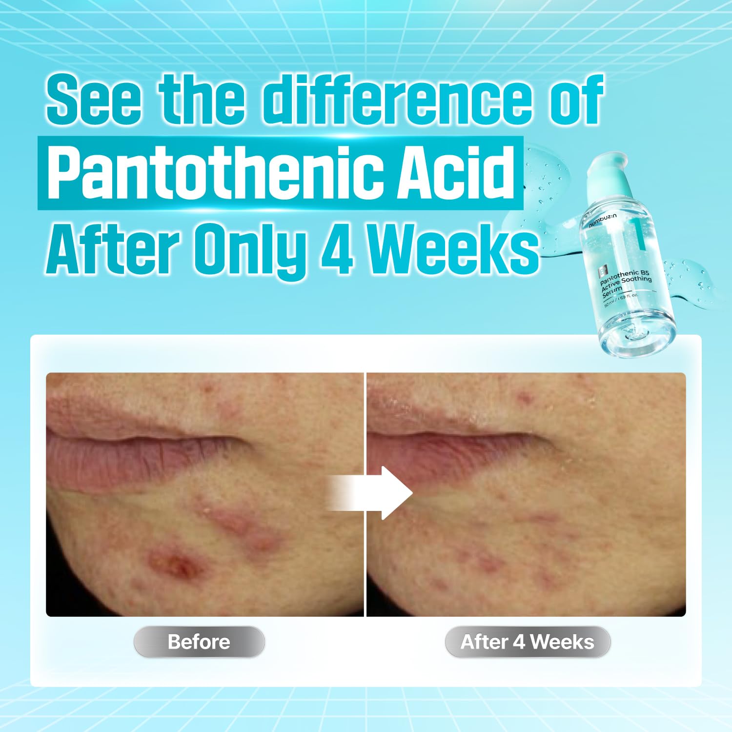 numbuzin Suero No.1 | Suero Calmante Activo Pantoténico B5 | Calmante, Hidratante | Ácido Pantoténico, Niacinamida | Control Del Exceso De Aceite, Reduce Los Brotes, Acné | Piel Grasa, Propensa Al Acn