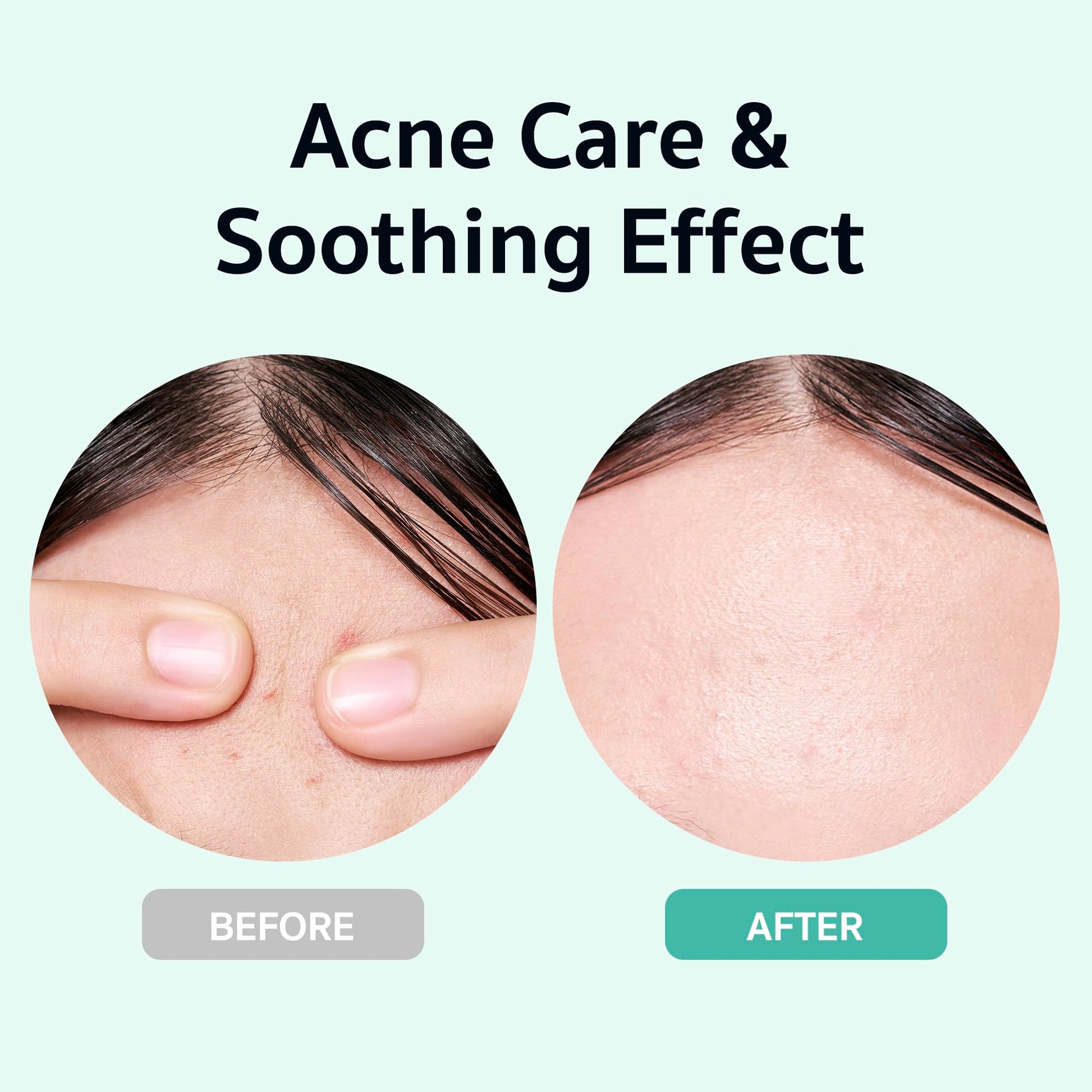 BRINGGREEN Zinc Teca Trouble Serum | Suero para el acné, cuidado de la piel coreano, suero facial, 3 días, cuidado de los poros