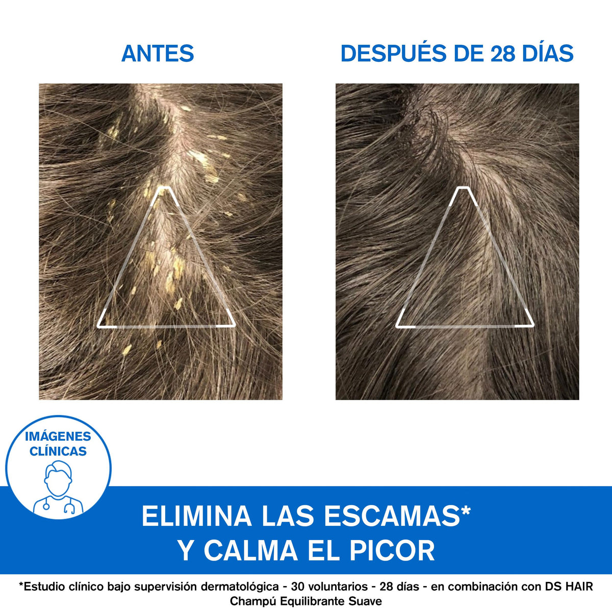 Uriage DS Hair Shampoo para la Caspa Severa con Ácido Láctico al 1.8% 150ml - Elimina las escamas, purifica, calma el picor y protege el cuero cabelludo. Deja el cabello brillante y de aspecto saludable - Espuma calmante, aroma fresco y floral - Sin jabón