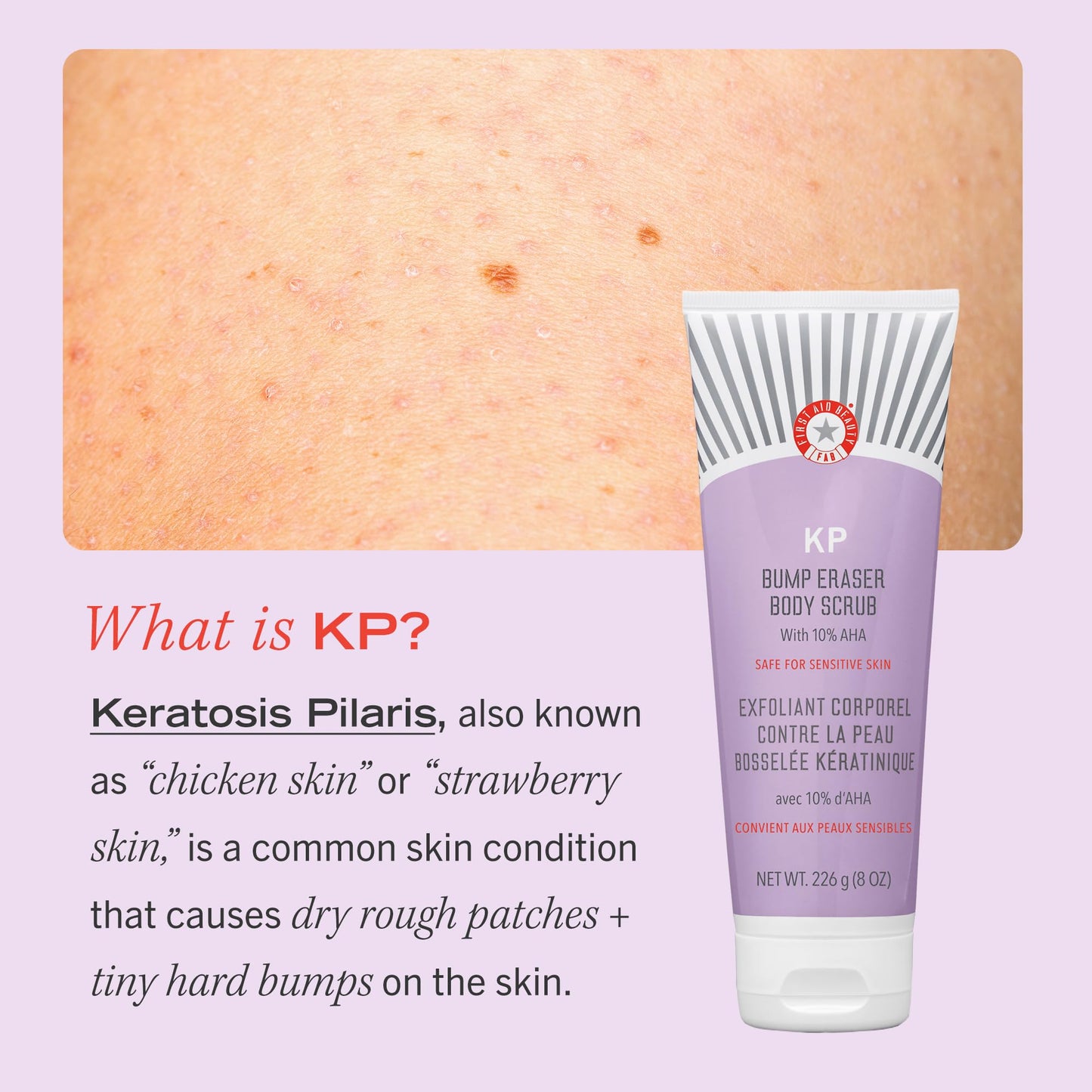 First Aid Beauty- Exfoliante corporal KP Bump Eraser con 10% de AHA, exfoliante para piel con queratosis pilaris con ácido glicólico y lactosa.