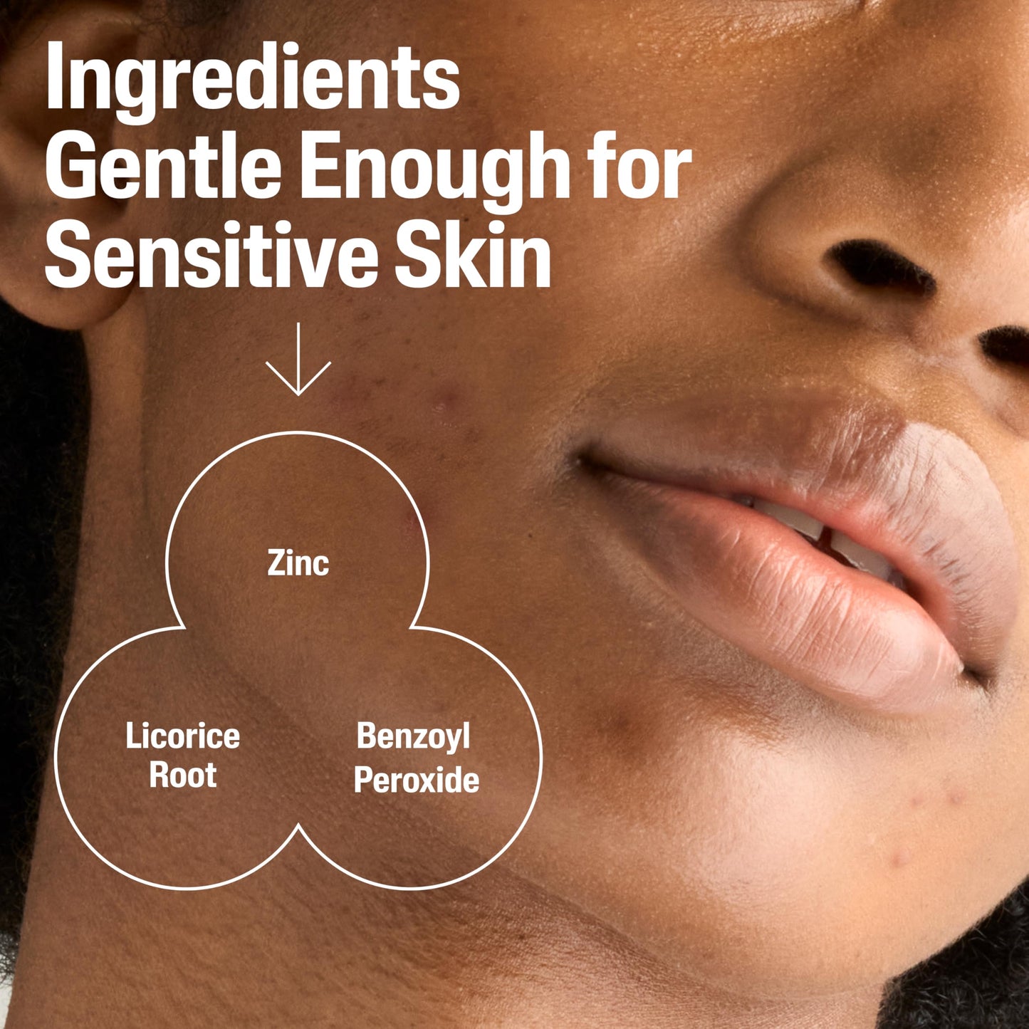 Cetaphil Gentle Clear Complexion-Clearing BPO Acne Cleanser