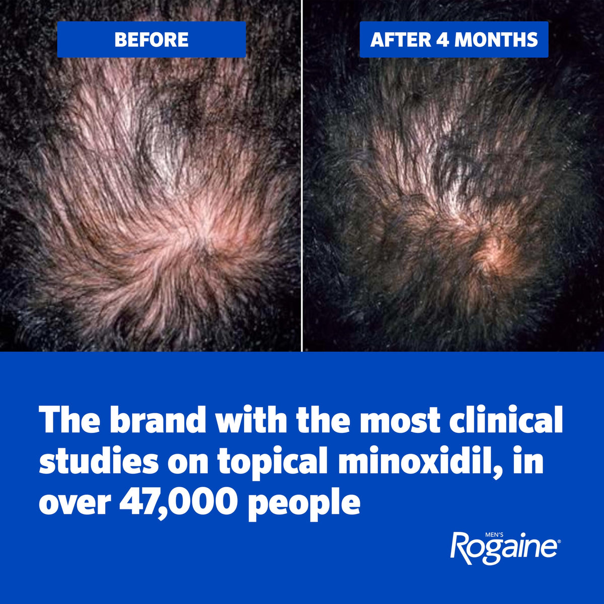 Solución Tópica Men Rogaine 5% Minoxidil Extra Strength para Regeneración del Cabello para Hombre