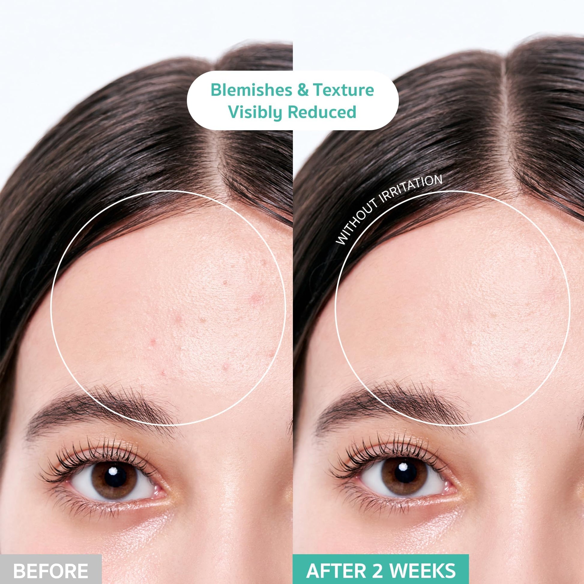 BRING GREEN Tea Tree Cica Crema Calmante Plus 100 Ml Coreano Cuidado de La Piel, Calmante y Calmante, Hidratante para La Piel, Crema Facial, Cuidado de Problemas, Cuidado de Los Poros Eliminación de P