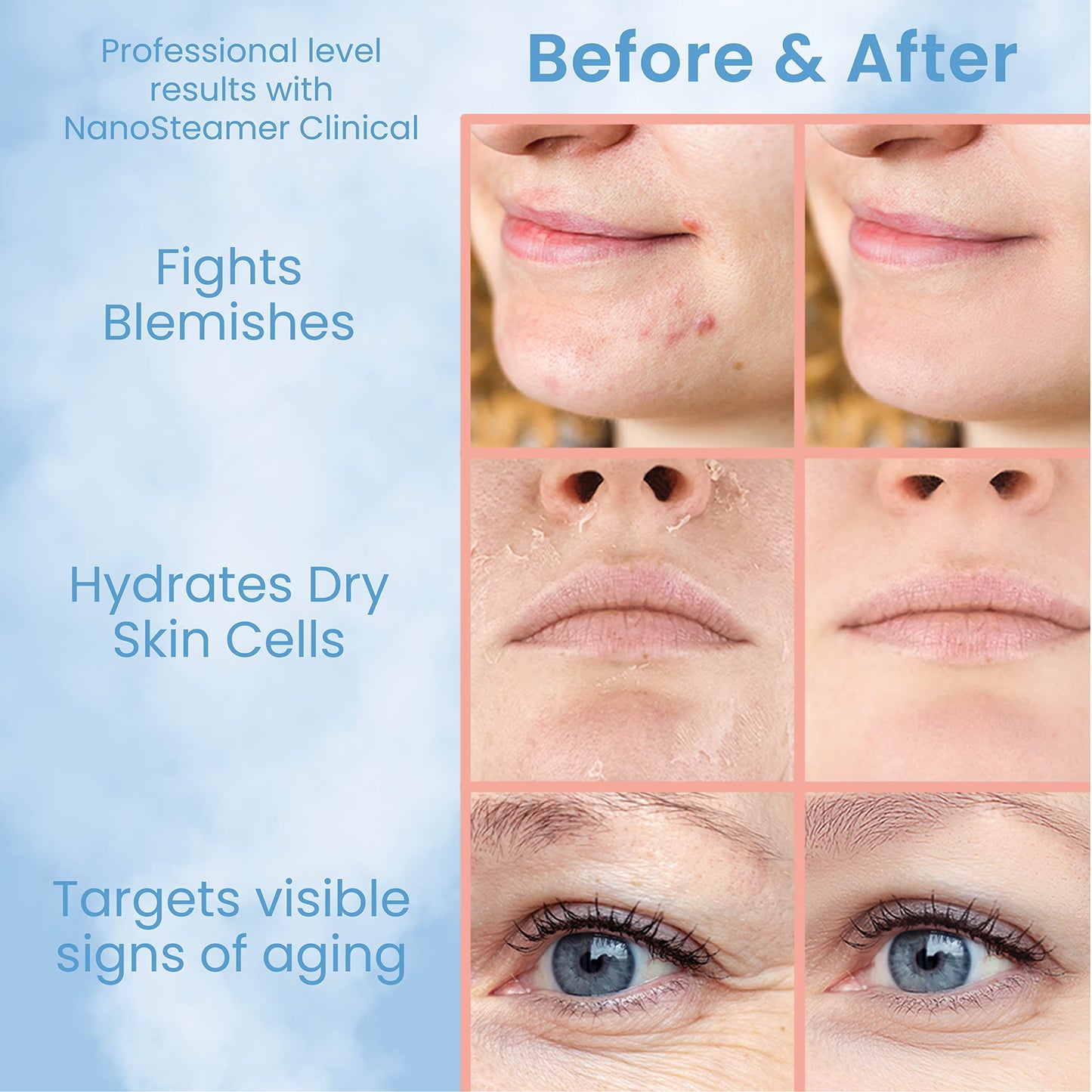 NanoSteamer Clinical - Vaporizador facial de grado dermatológico