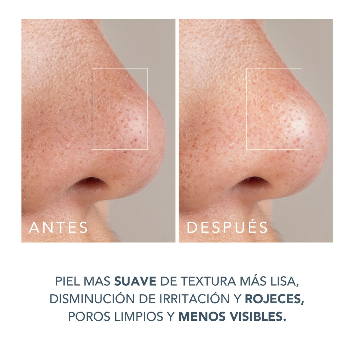 FOREO KIWI DERMA Bundle – Microdermoabrasión con punta diamante – Limpiador facial eléctrico + LUNA Micro-Foam Cleanser 2.0 con ácido salicílico – Succionador puntos negros – Limpieza poros piel grasa