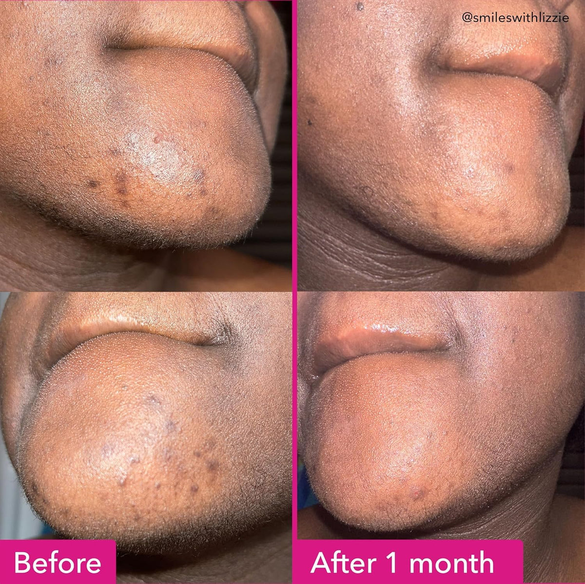 Good Molecules Barra Iluminadora Y Antimanchas - Barra Facial Y Corporal Sin Jabón - Ácido Tranexámico, Ácido Kójico Y Niacinamida Para Combatir Las Manchas Oscuras - Cuidado De La Piel