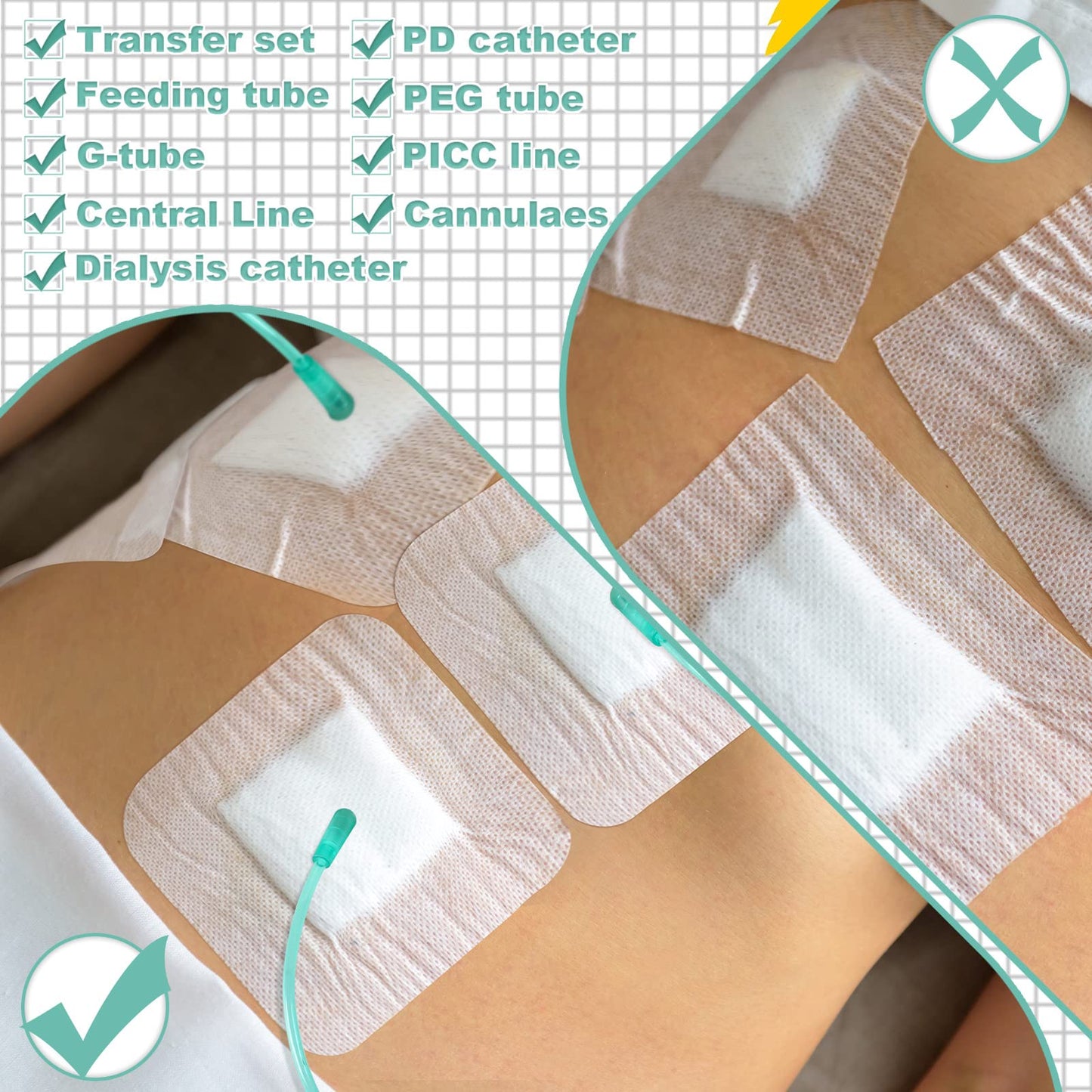 Woanger 75 Almohadillas para Tubos de Alimentación de 4 x 4 Pulgadas Vendajes Adhesivos de Tubos de Drenaje Dividido Fundas de Tubos G de Catéter PD Accesorios de Diálisis Suministros de Tubos G