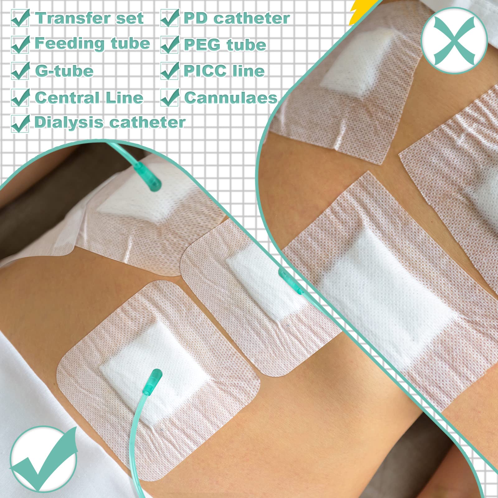 Woanger 75 Almohadillas para Tubos de Alimentación de 4 x 4 Pulgadas Vendajes Adhesivos de Tubos de Drenaje Dividido Fundas de Tubos G de Catéter PD Accesorios de Diálisis Suministros de Tubos G