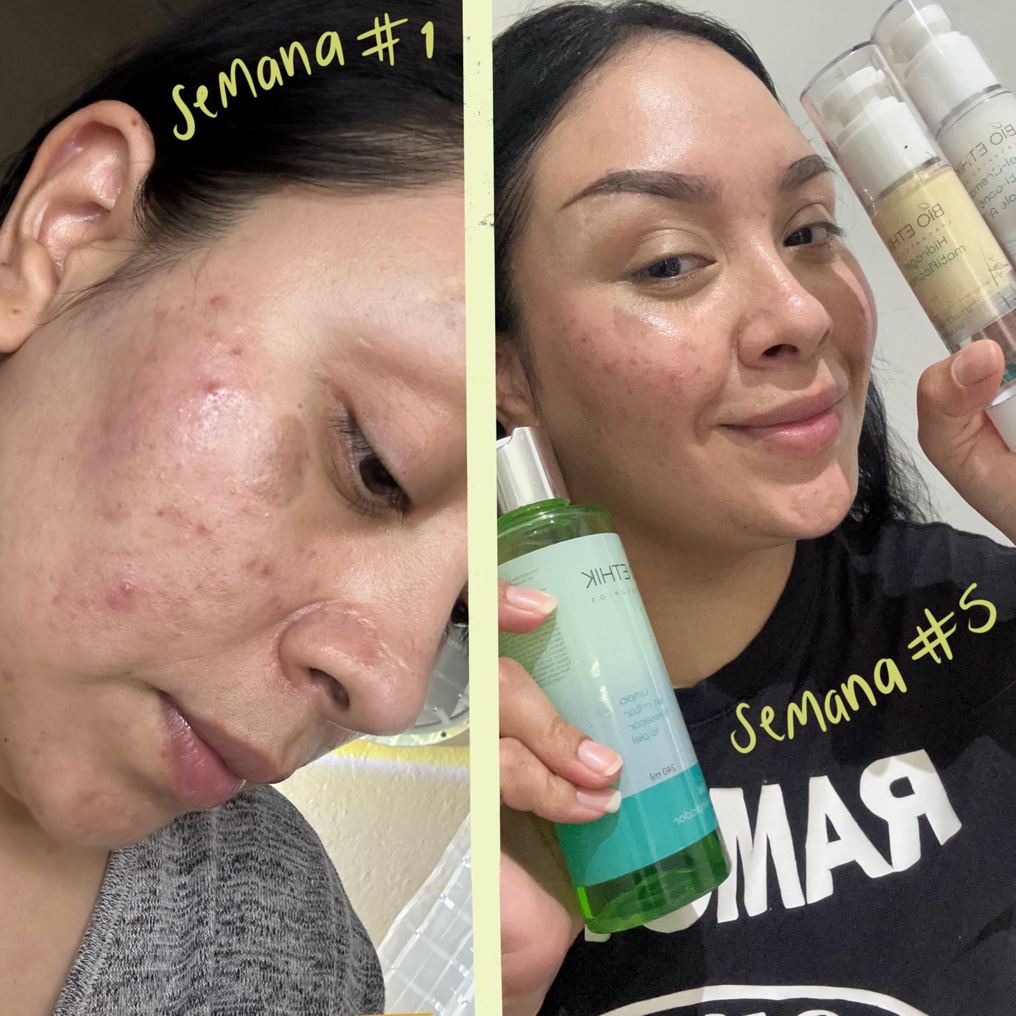 Bio Ethik Gel Crema Anti Acne Triple A para Pieles Sensible 50gr| Controla y Desinflama Granos y Puntos Negros