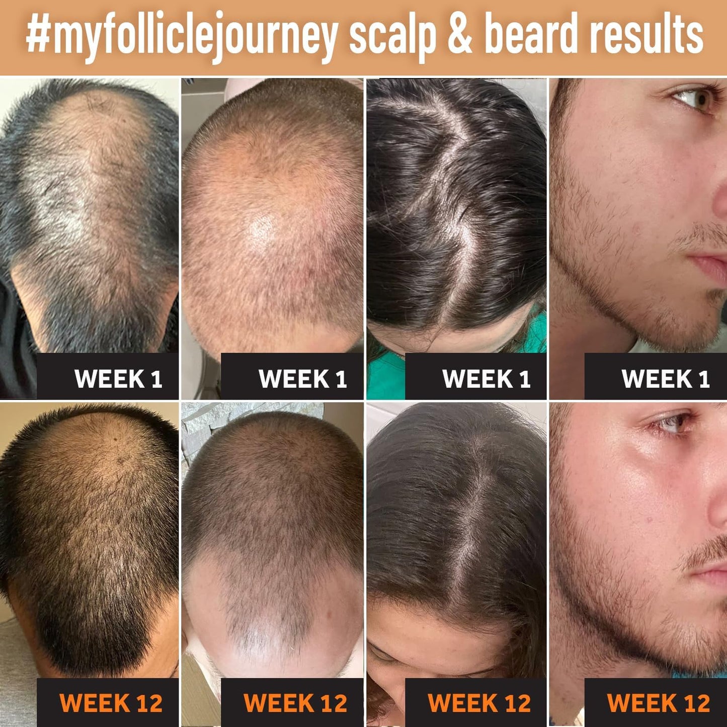 FOLLICLE BOOSTER Masajeador Manual para Cuero Cabelludo Y Barba - Depurador de Cabello de Silicona, Cepillo de Cuidado de Limpieza - Exfoliante Ergonómico para Eliminar La Caspa Que Promueve El Crecim