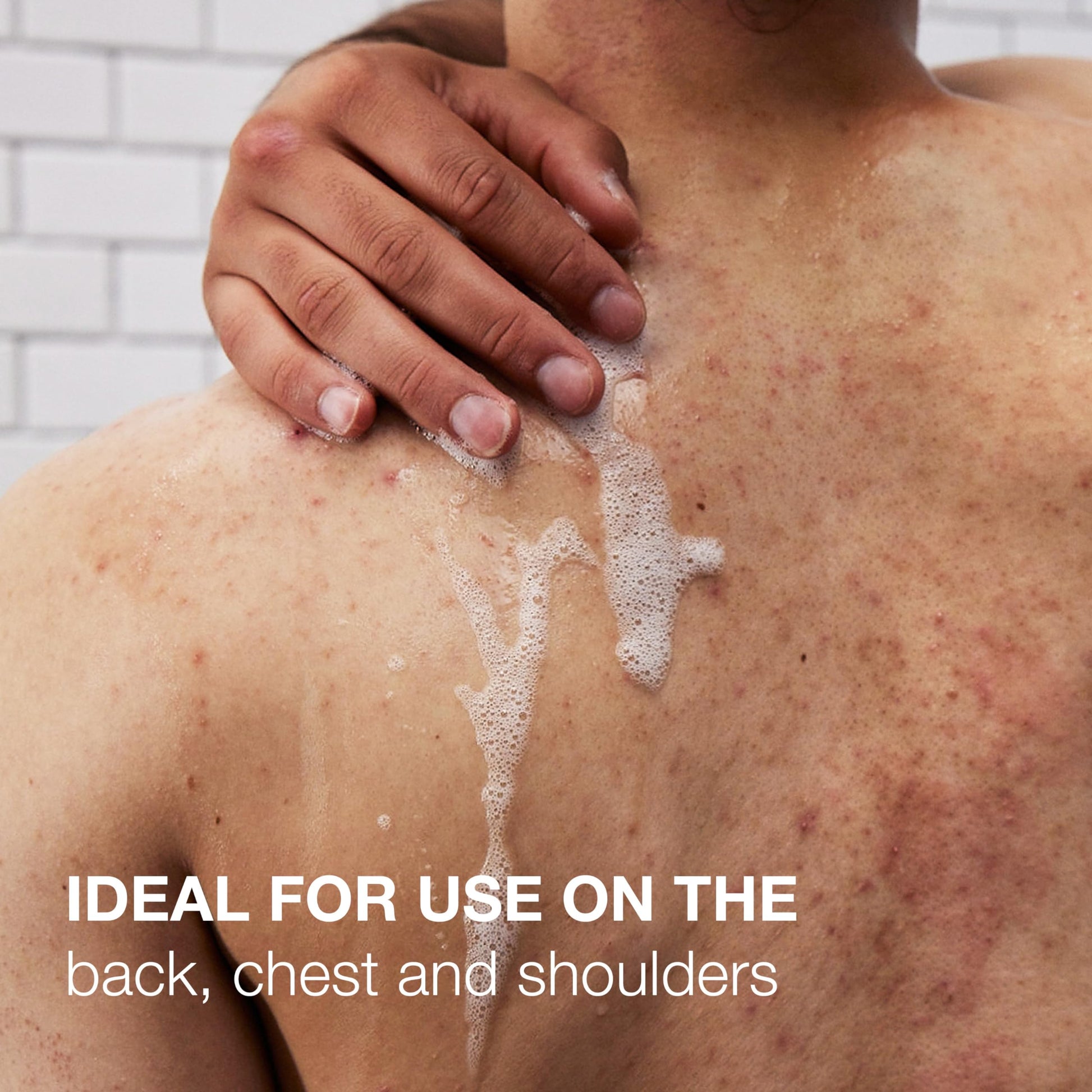 Neutrogena Stubborn Body Acne Cleanser & Exfoliator con Ácido Salicílico y PHA para piel susceptible a Acné