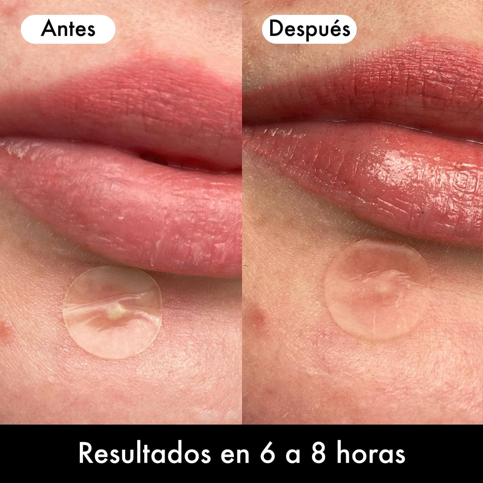 HERO MIGHTY PATCH Invisible + 36 Parches Hidrocoloide para Acné | Efecto Rápido