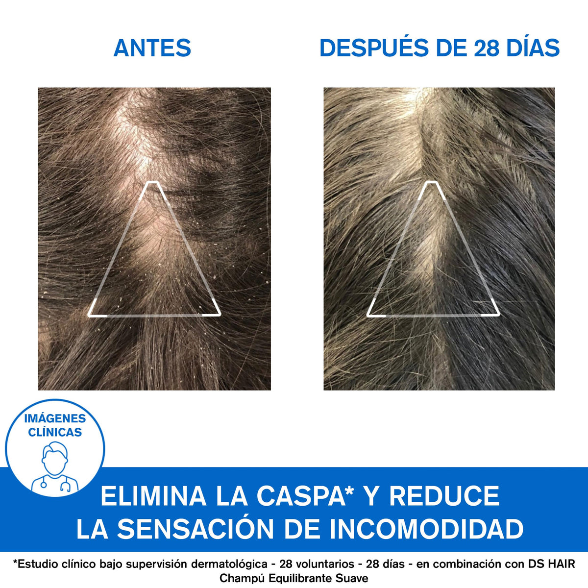 Uriage DS Shampoo Caspa moderada con Piroctona Olamina 200ml - Elimina la Caspa Seca y Grasa, Reduce la Sensación de incomodidad. Deja el Cabello Brillante y de aspecto saludable - Champú Espuma Cremosa, Aroma Fresco y Floral - Sin Jabón