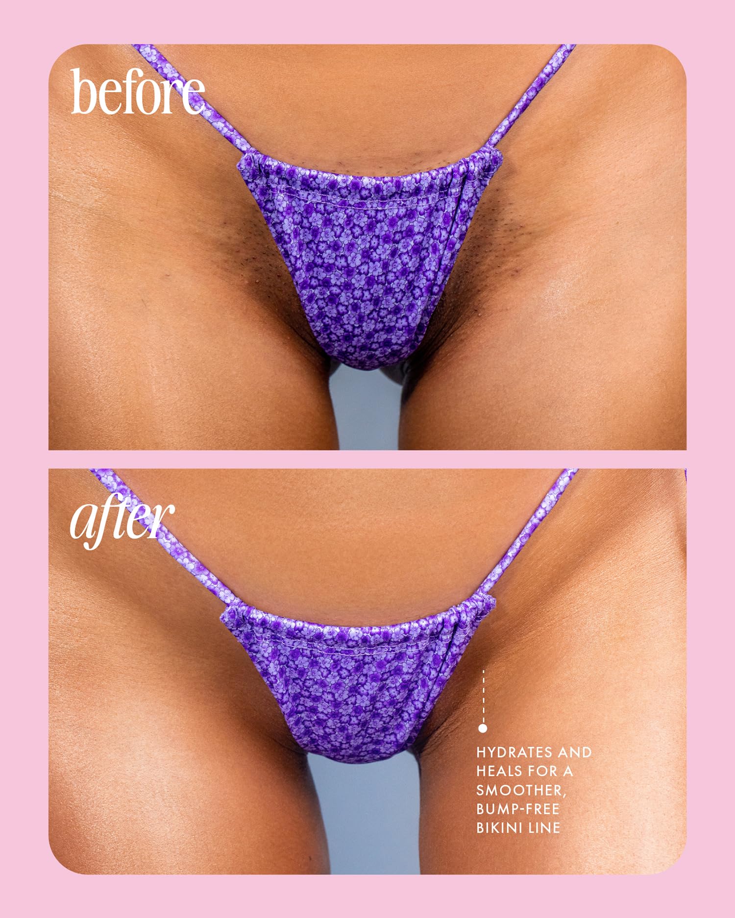 Truly Beauty Cooka Concentrado Suero Encarnado - Tratamiento Para El Cabello Encarnado Para El Área Del Bikini - Fórmula Suavizante Y Calmante Para Después Del Afeitado - Cura Quemaduras, Mellas Y Enc