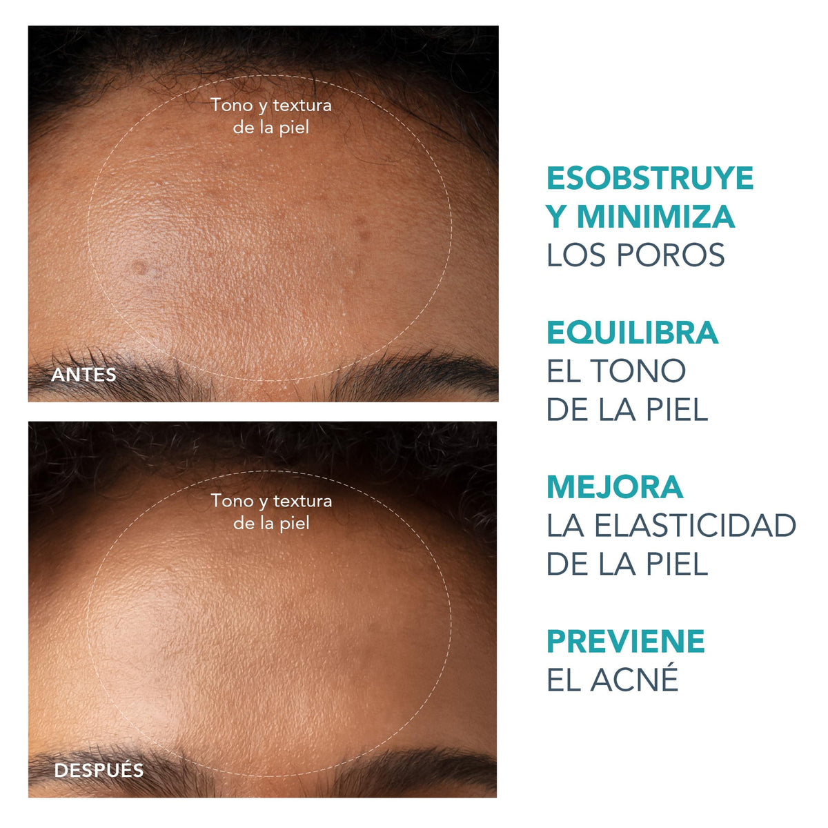 FOREO KIWI – Limpiador facial eléctrico – Succionador de puntos negros – Exfoliante facial con punta de diamante – Eliminación de espinillas y granos – Limpieza profunda de poros