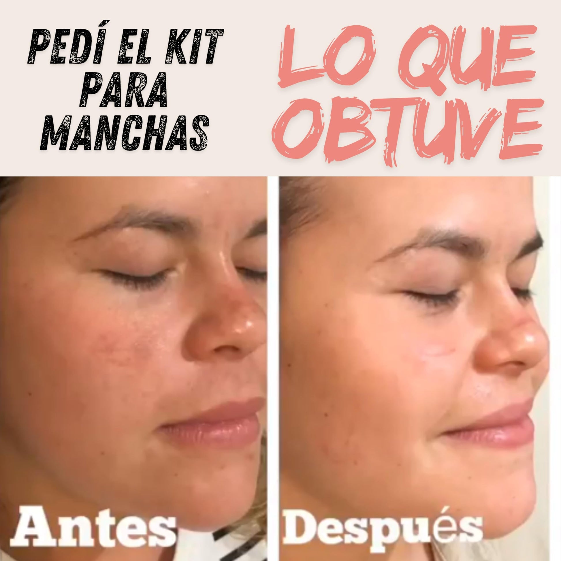 Kit para manchas faciales con crema despigmentante con 2% de hidroquinona, suero de vitamina C, suero de niacinamida, suero de ácido hialurónico, crema de día y limpiador facial | Tu Piel Dra Lietza |