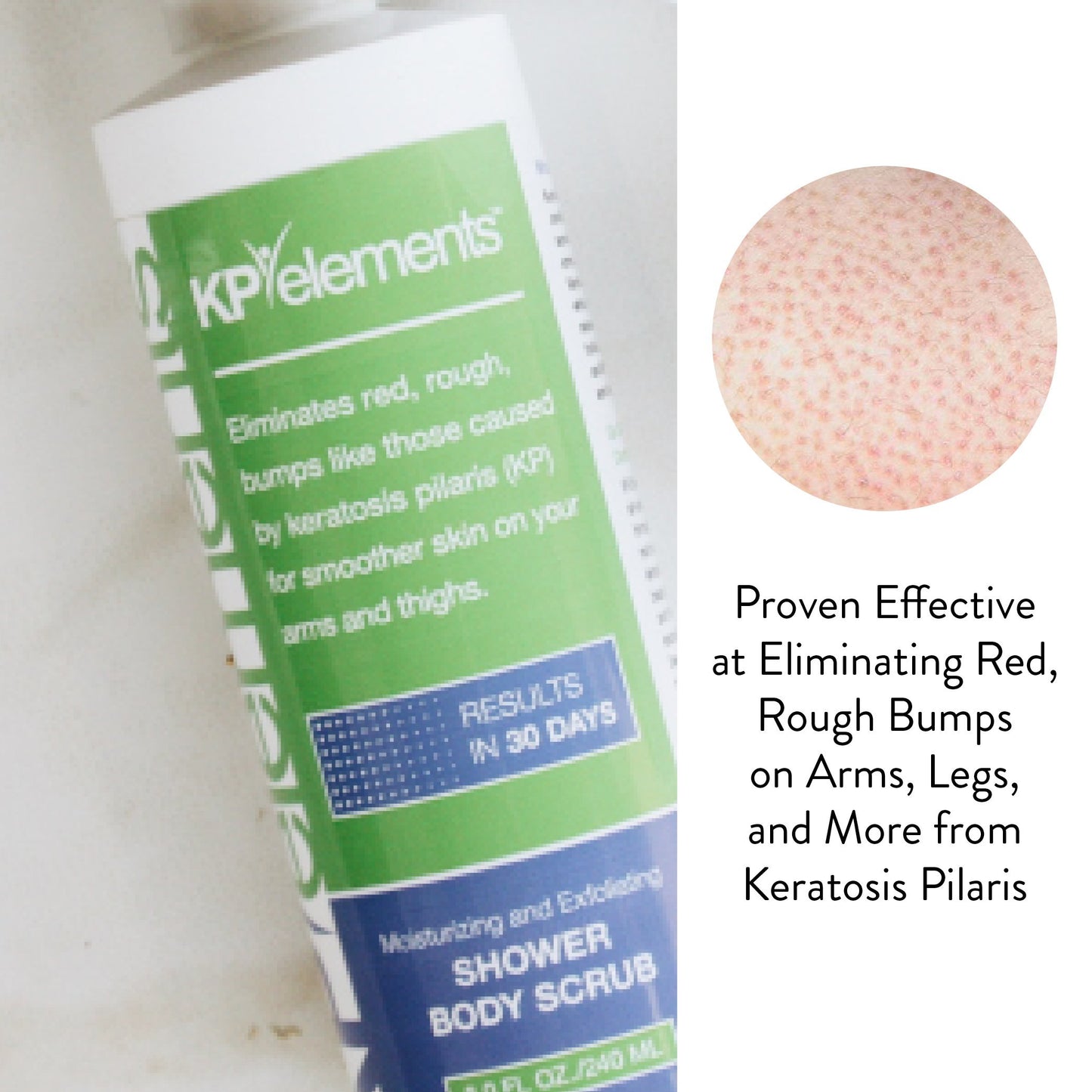 KP Elements Body Scrub - Keratosis Pilaris Treatment - Clear up Red Bumps on Your Arms and Thighs by combining this KP Scrub with Our KP Treatment Cream (1)