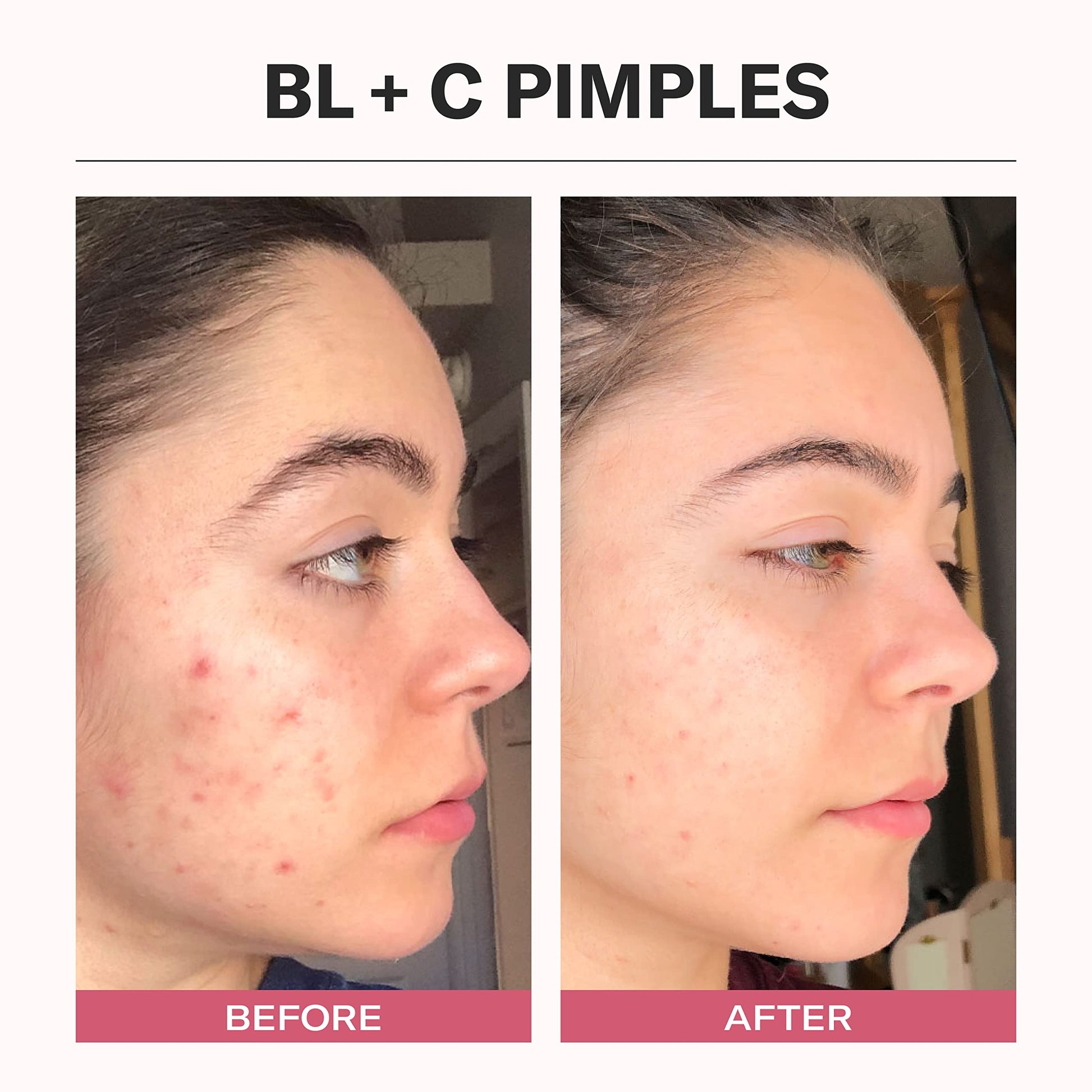OdacitÃ | Bl+C Pimples Facial Serum Concentrate | Black Cumin & Cajeput | Achieve Blemish-Free Skin | For Oily & Acne-Prone Skin | Natural, Vegan & Cruelty-Free | 5ml