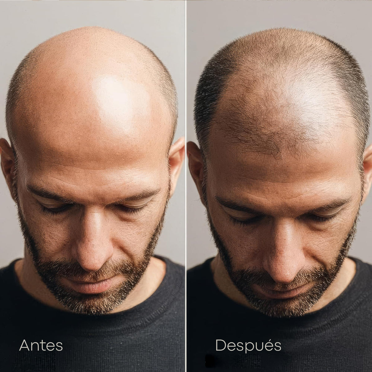 Spray Anticaída Anacastel Minoxidil 5% 60 ml